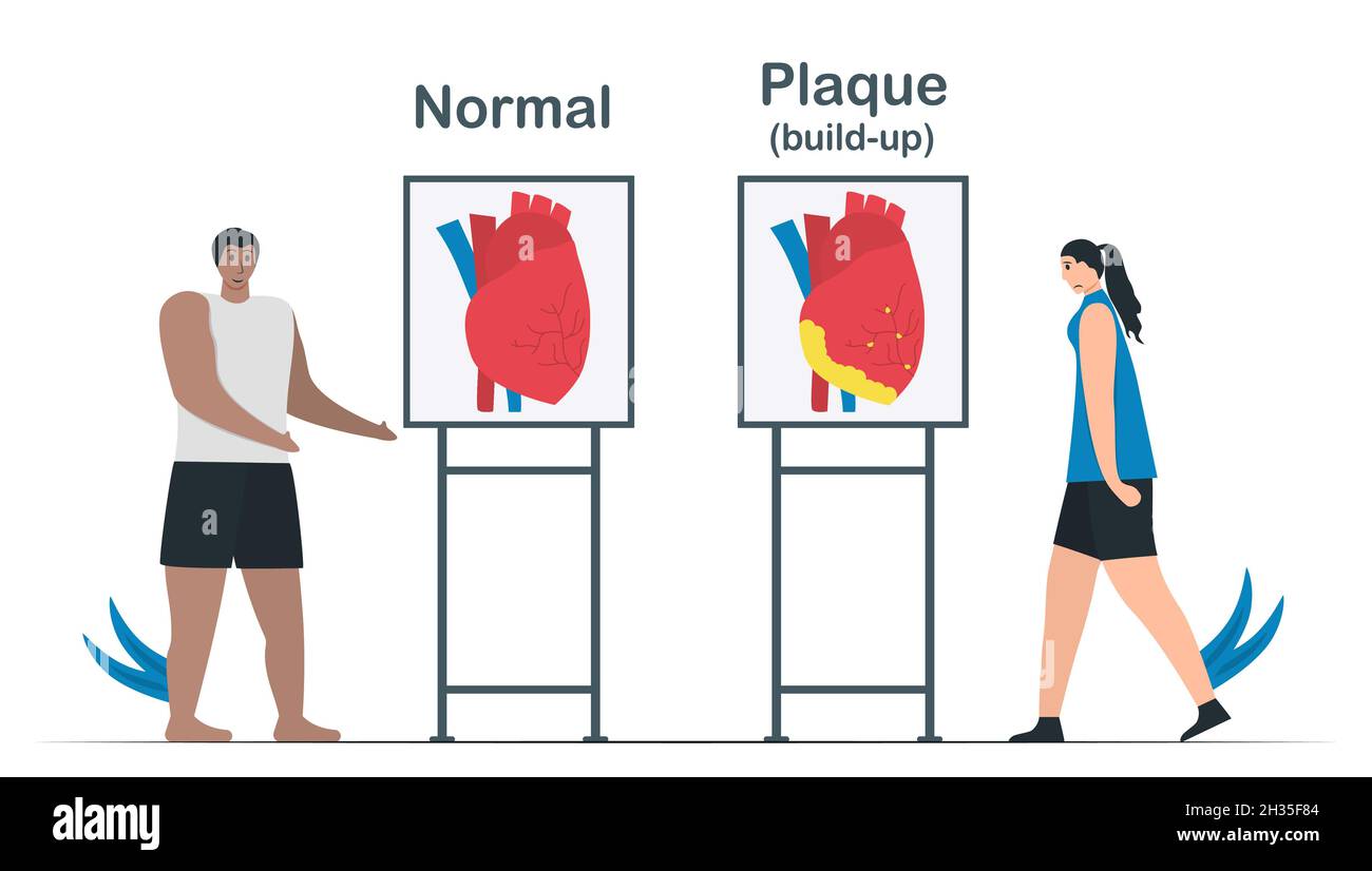 Confronto tra cardiopatia normale e coronaropatia. L'accumulo di placche può crearsi di depositi di colesterolo nell'arteria. Illustrazione del vettore di cardiologia Illustrazione Vettoriale