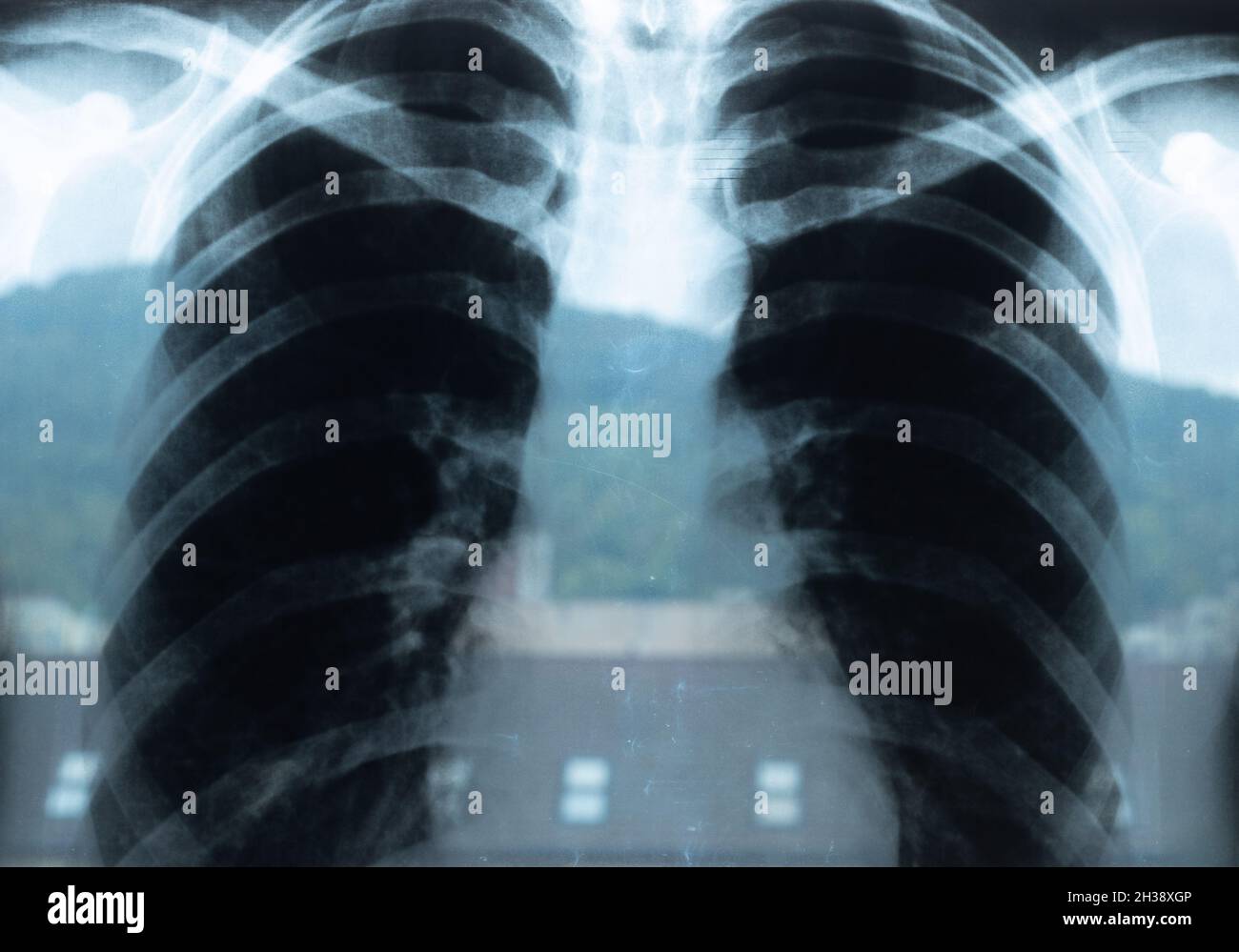 Radiografia toracica, radiografia polmonare dopo un'infezione covid 19 Foto Stock