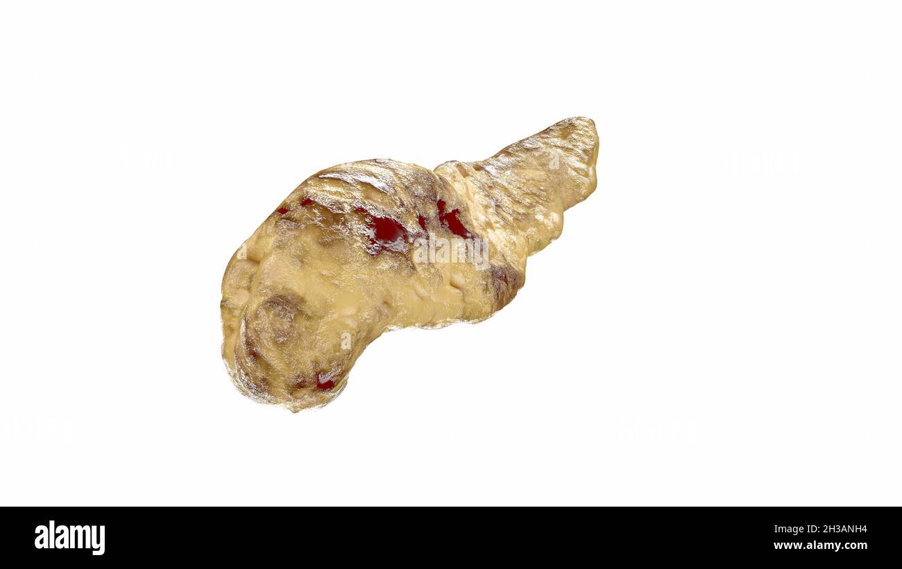 Pancreatite del pancreas umano isolato su bianco. Pancreatite emorragica acuta con necrosi grassa del pancreas. illustrazione 3d Foto Stock