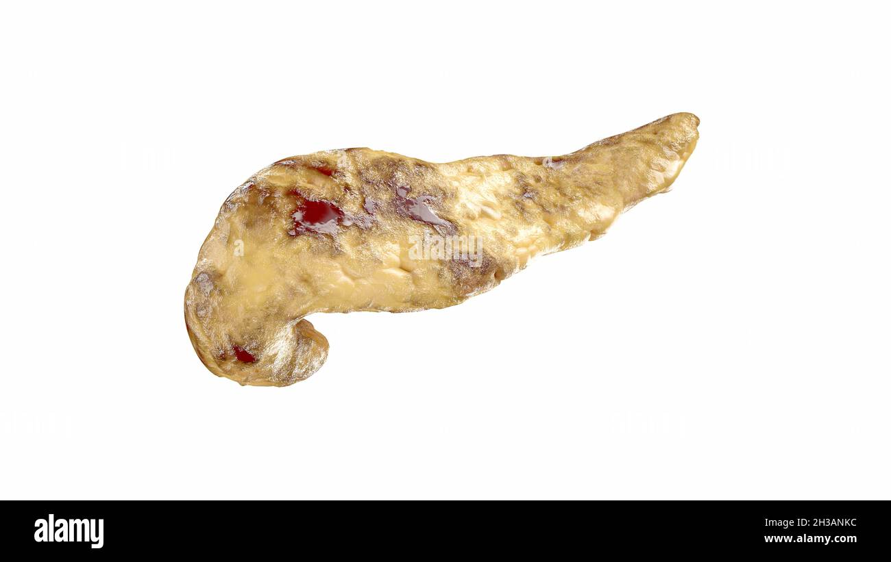 Pancreatite del pancreas umano isolato su bianco. Pancreatite emorragica acuta con necrosi grassa del pancreas. illustrazione 3d Foto Stock