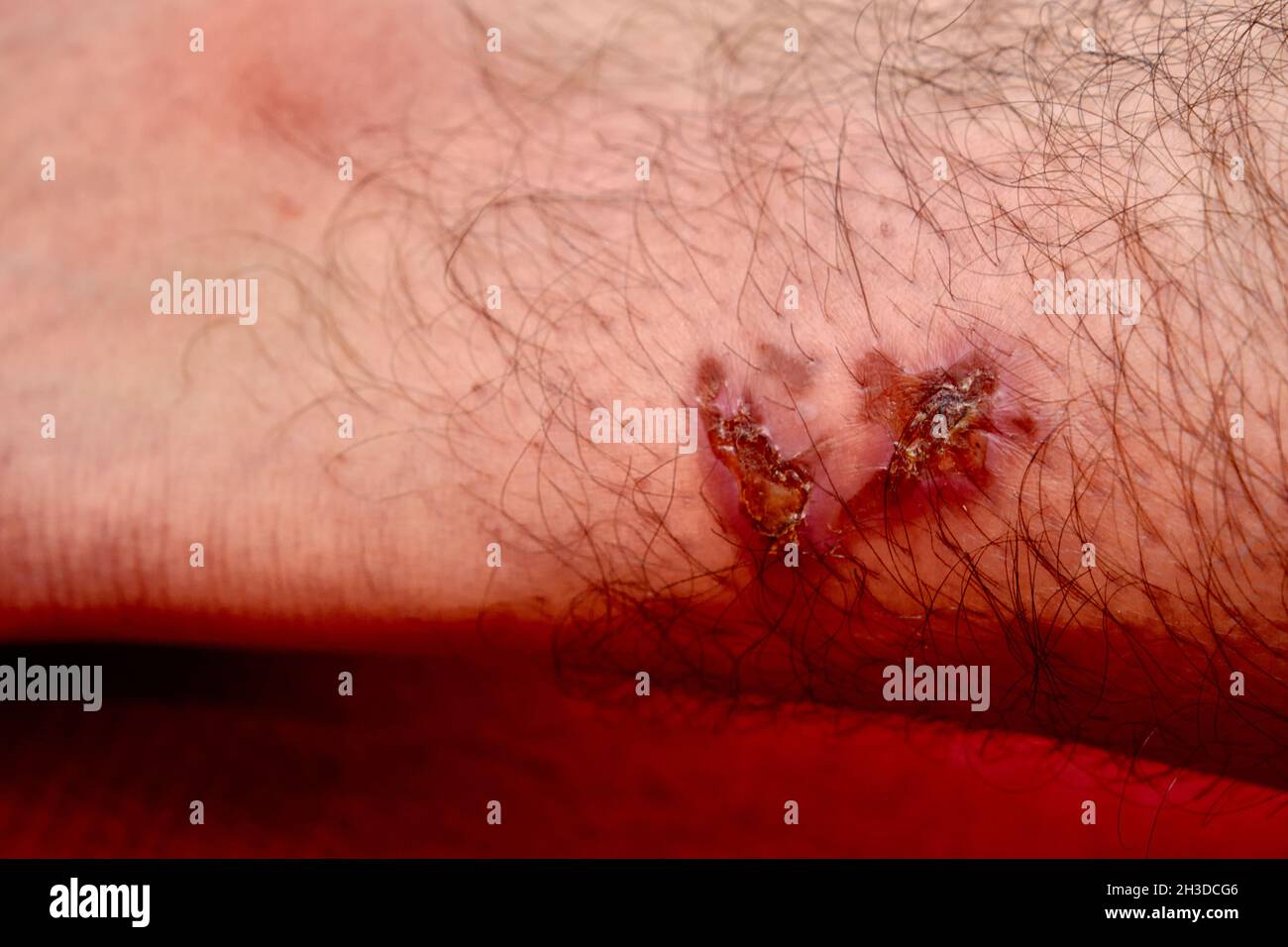 Una grande cicatrice in una gamba di un uomo Foto Stock