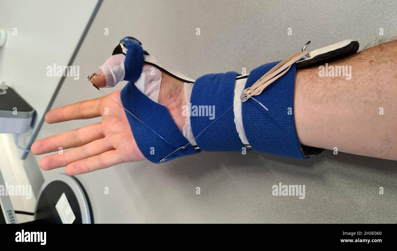mano con la stecca dopo il taglio del tendine flessibile del pollice Foto Stock