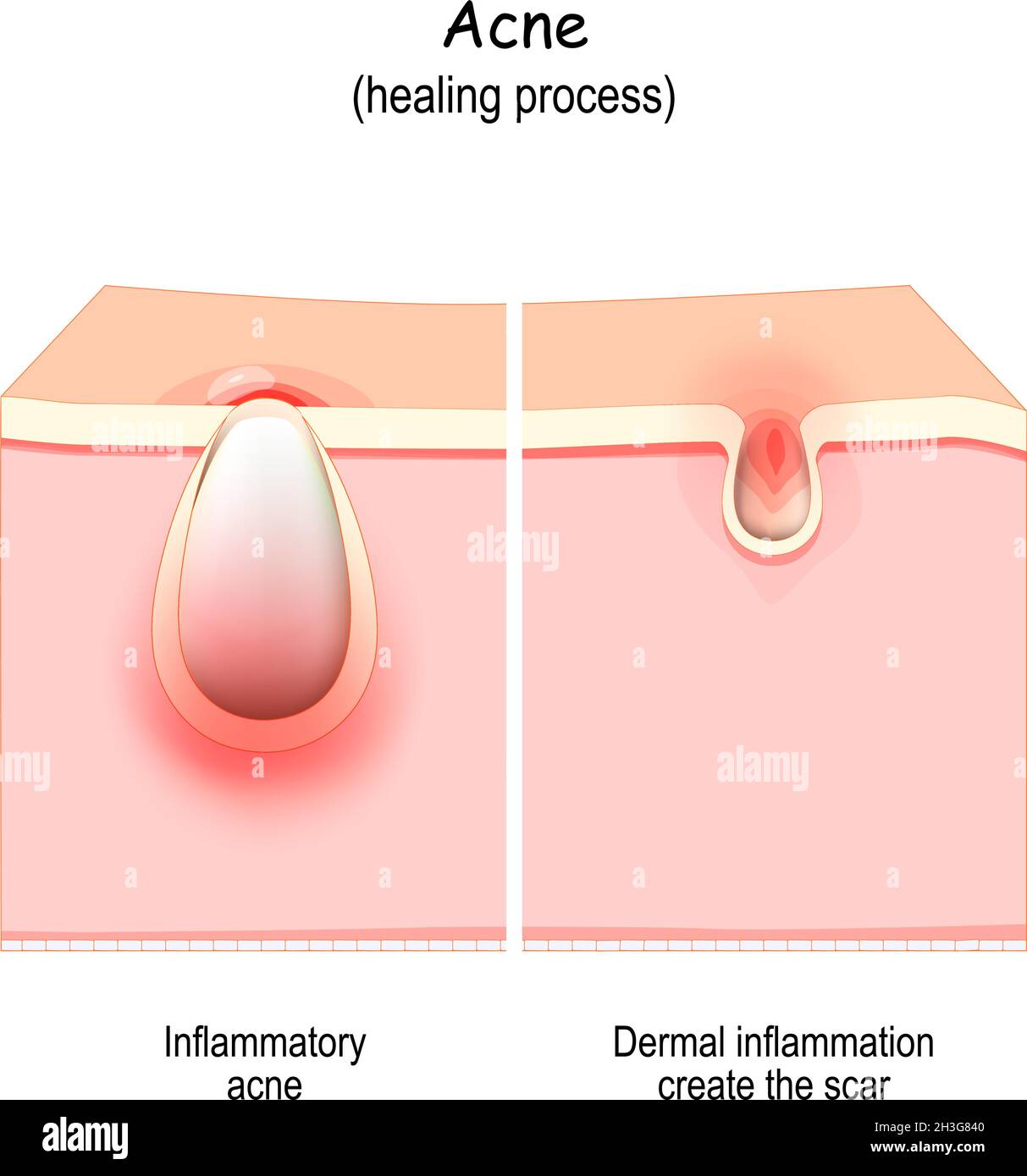 Le cicatrici dell'acne sono causate da infiammazione all'interno del derma. Guarigione anormale di vulgaris acne. Illustrazione vettoriale Illustrazione Vettoriale