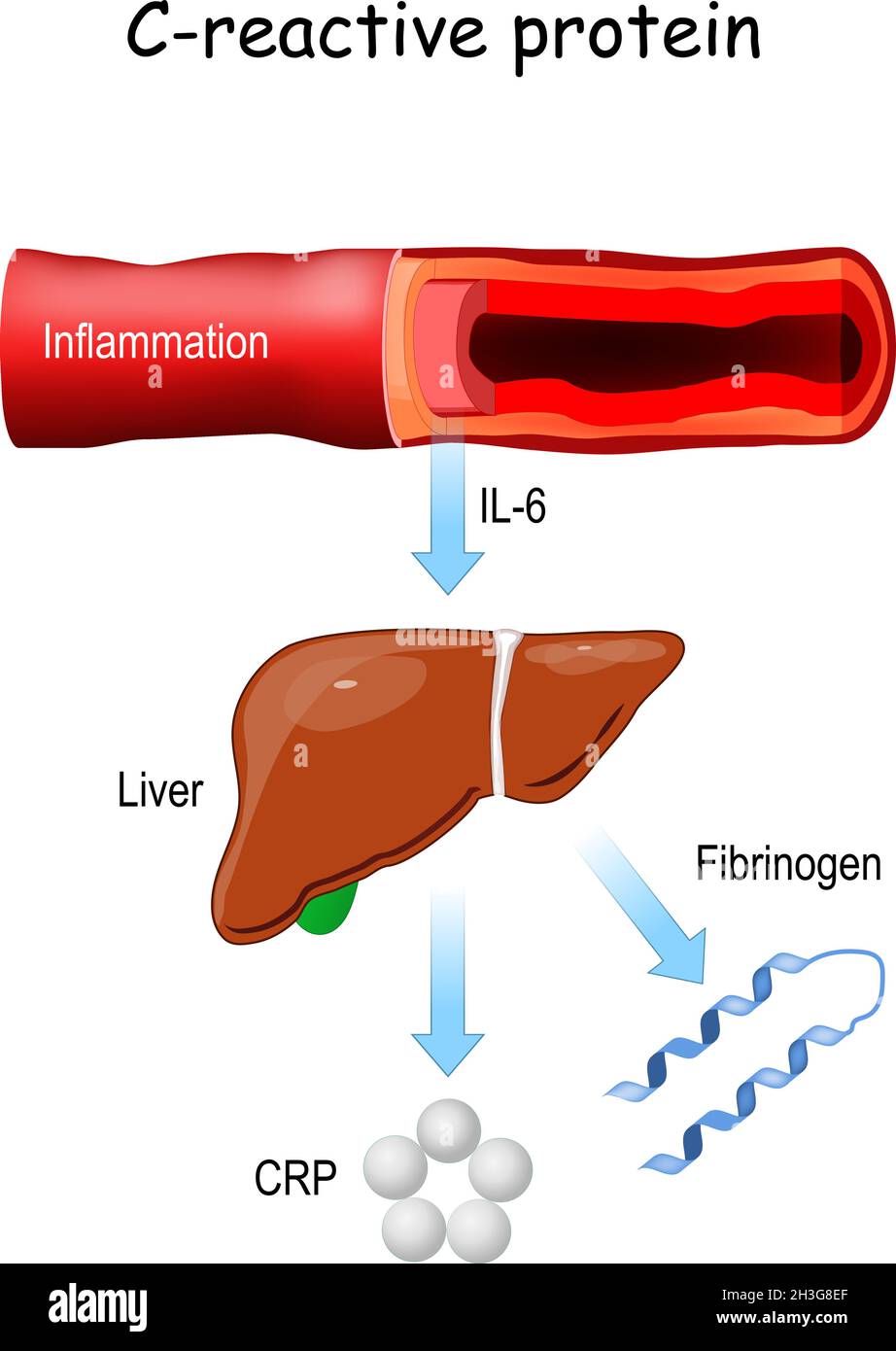 Proteina C-reattiva, e citochina pro-infiammatoria il-6. Infiammazione dei vasi sanguigni. Rilascio epatico di fibrinogeno e CRP. Illustrazione Vettoriale