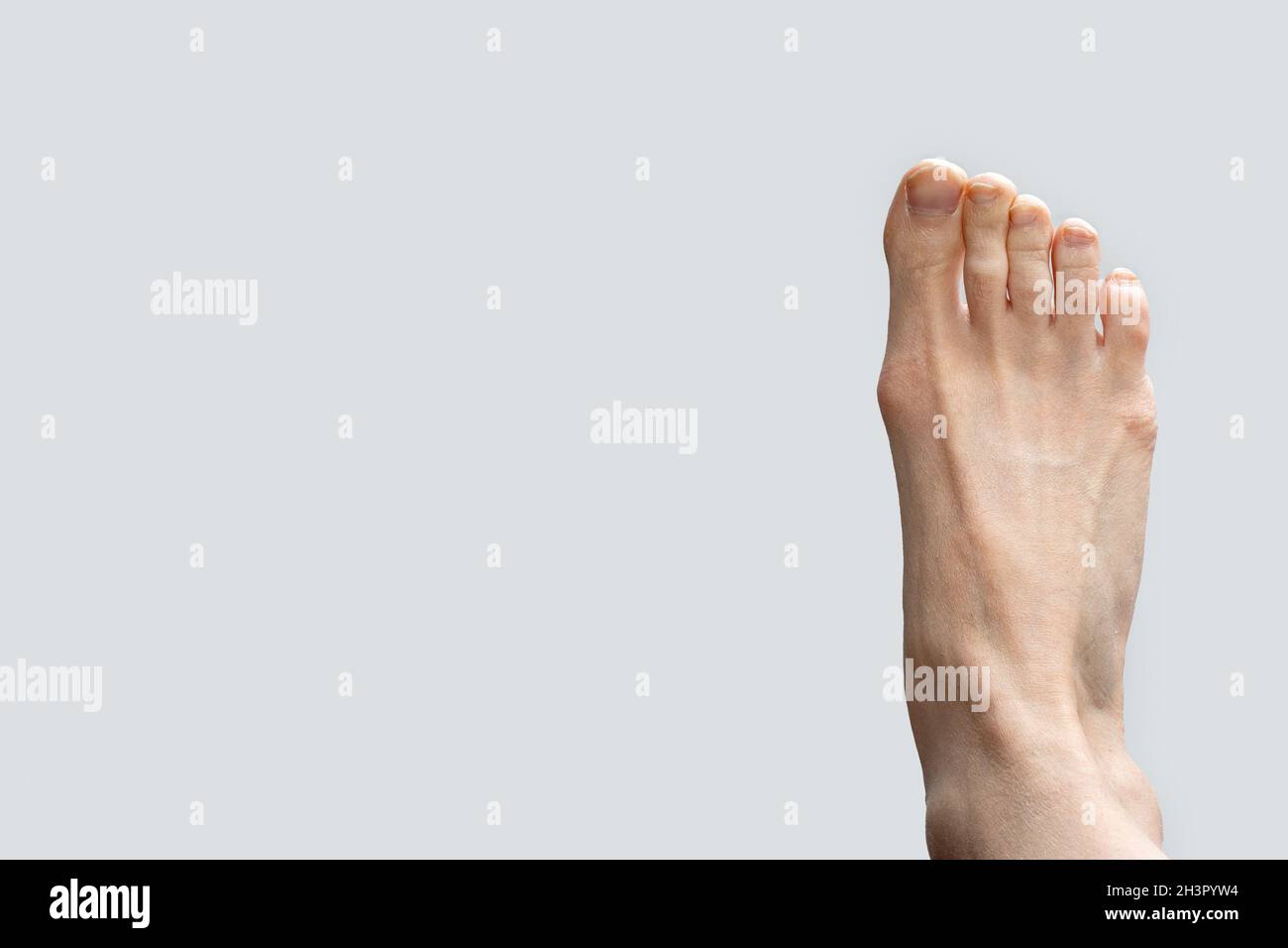 Allux valgus, borsite del piede su sfondo grigio. Fungo delle unghie sulla malattia dei piedi. Deformazione delle articolazioni del piede. Il p Foto Stock