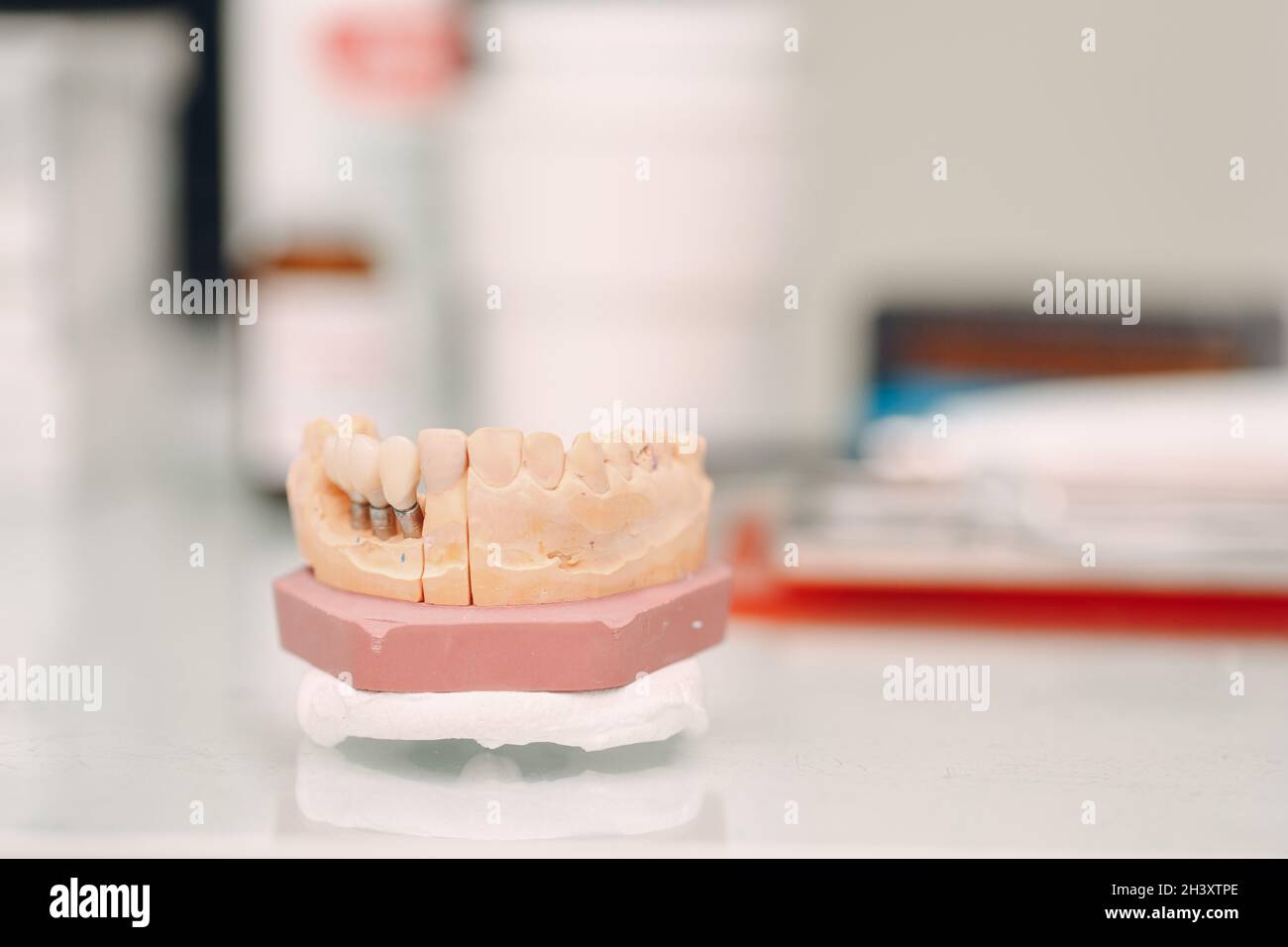 Disposizione dentale della mascella umana con denti e impianti. Foto Stock