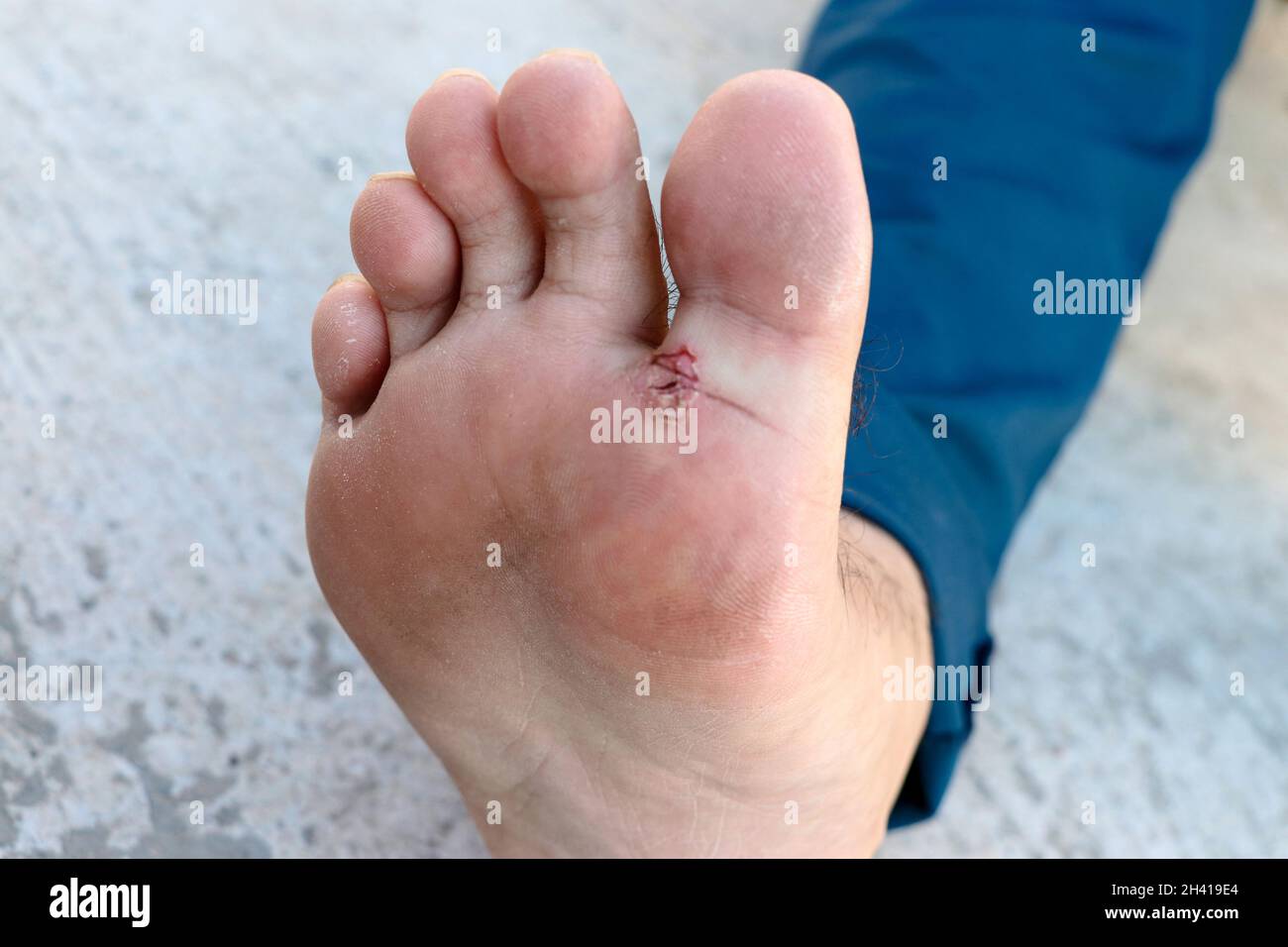 Piede dell'atleta - tinea pedis, infezione fungina o suola dei piedi con dermatite, il soggetto è fuoco morbido Foto Stock