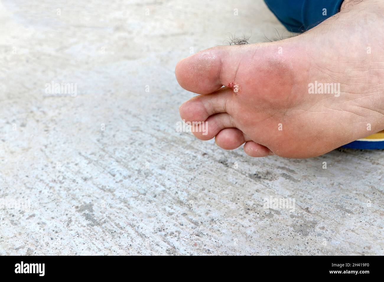 Piede dell'atleta - tinea pedis, infezione fungina o suola dei piedi con dermatite, il soggetto è fuoco morbido Foto Stock