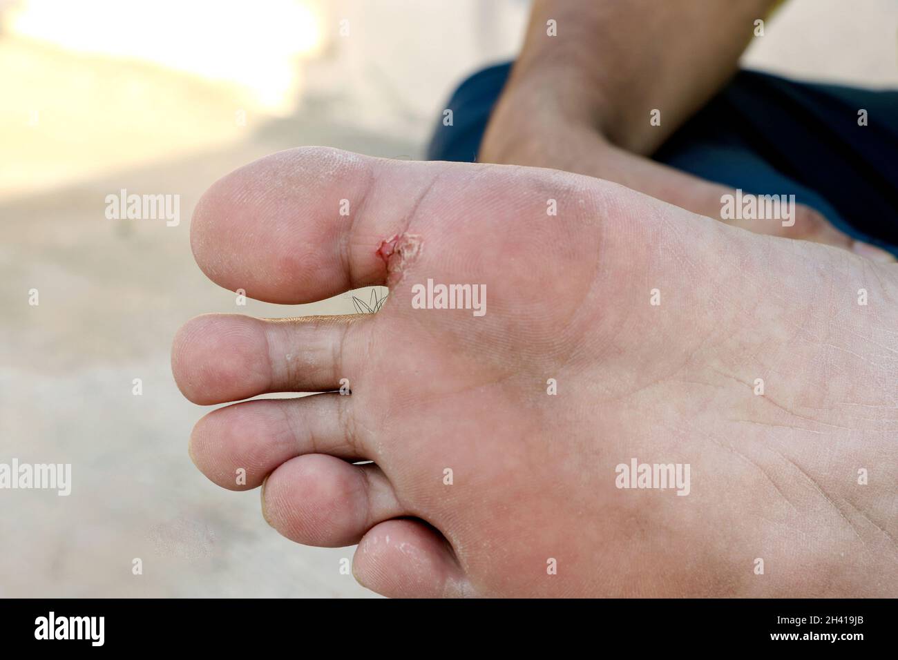 Piede dell'atleta - tinea pedis, infezione fungina o suola dei piedi con dermatite, il soggetto è fuoco morbido Foto Stock