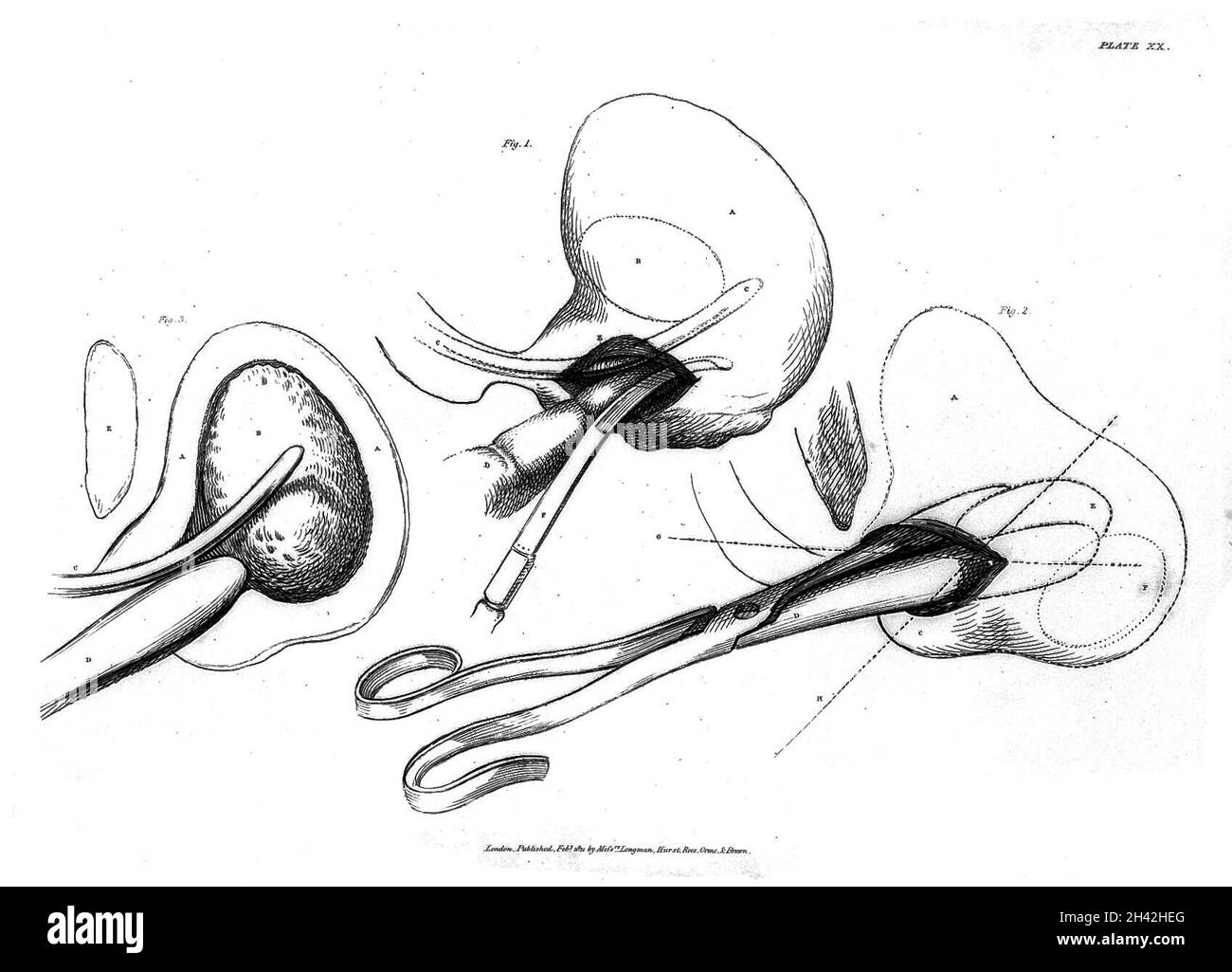 Targa xx 'illustrazioni delle grandi operazioni di chirurgia', 1820 Foto Stock