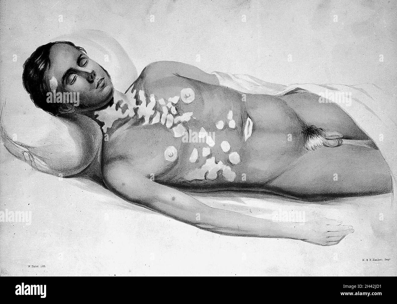 T. Addison, ON...capsule surrenali Foto Stock