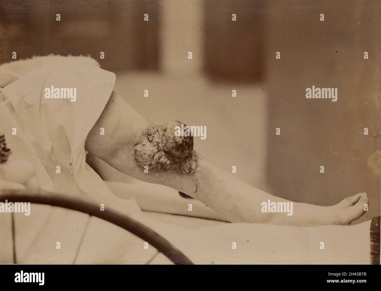 Gamba con crescita epiteliomatosa che si era sviluppata su una vecchia ulcera Foto Stock