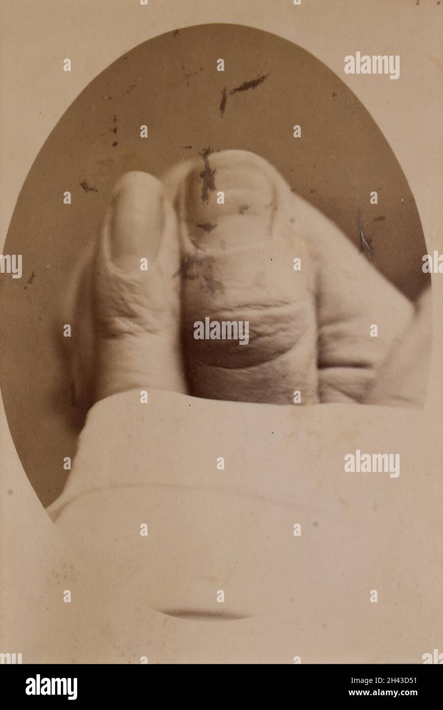 Segni sui chiodi del dito e del pollice causati da stagionalità Foto Stock