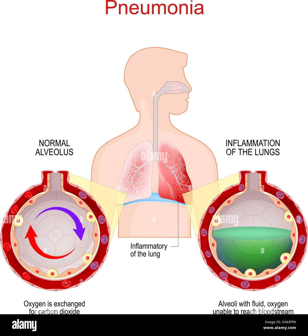 Polmonite. Infezione polmonare. Infiammatorio del sistema respiratorio. Primo piano di alveoli e alveoli sani con liquidi Illustrazione Vettoriale Polmonite. Infezione polmonare. Infiammatorio del sistema respiratorio. Primo piano di alveoli e alveoli sani con liquidi Illustrazione Vettoriale