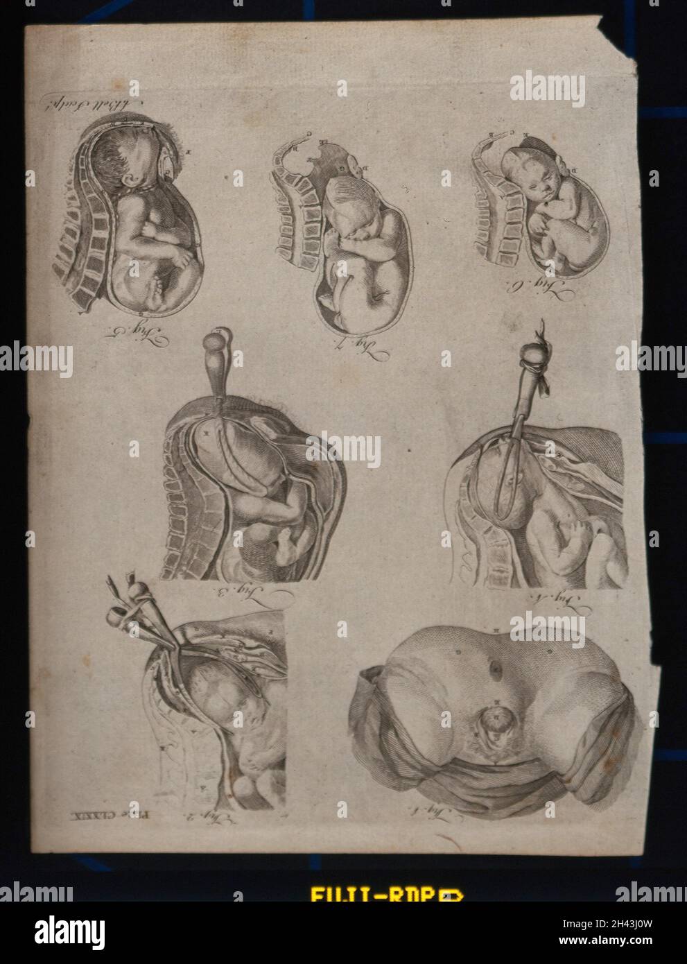 Cinque diagrammi che illustrano la nascita di un bambino con l'uso di forcipe. Incisione di A. Bell. Foto Stock
