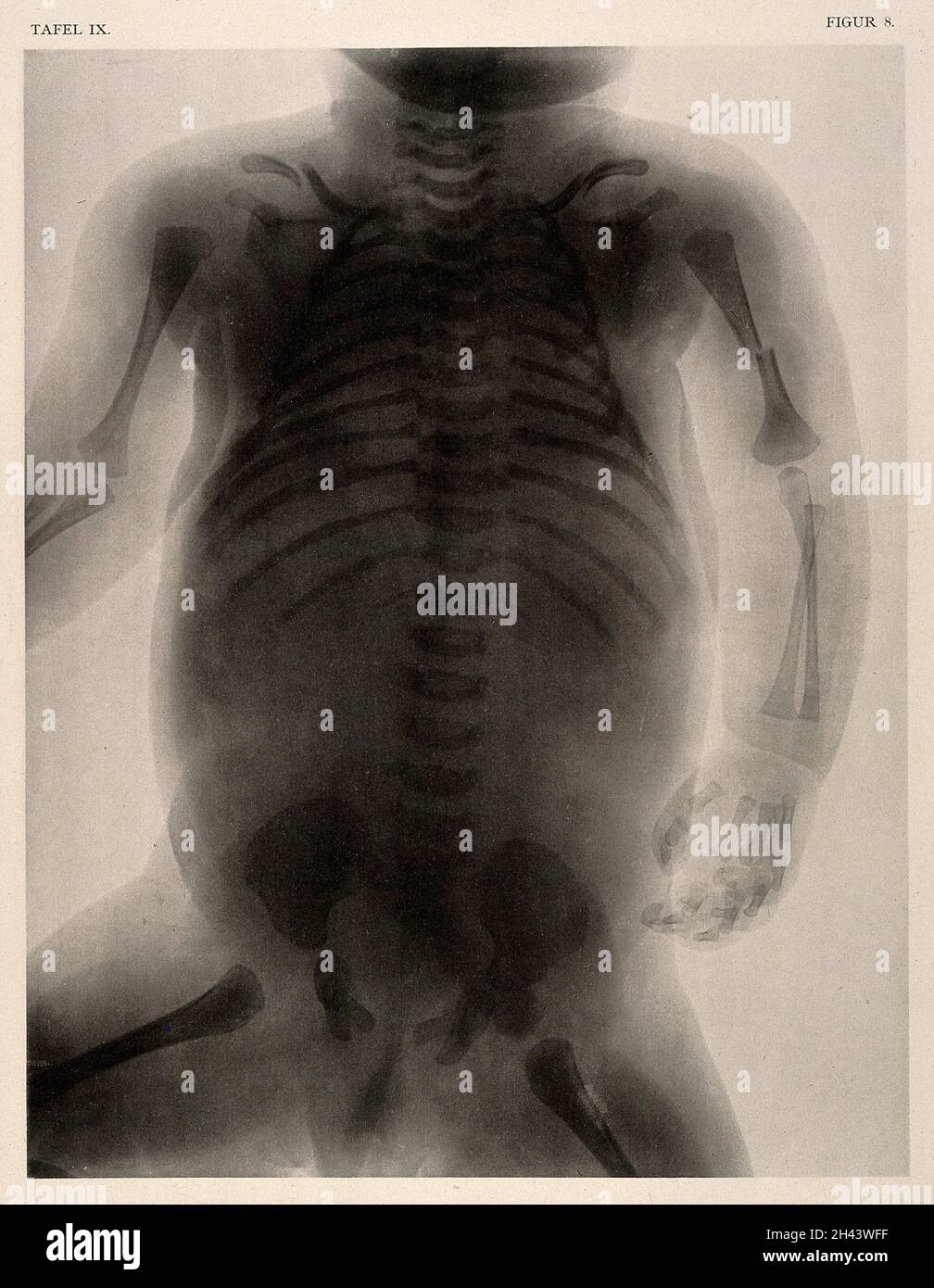 Uno scheletro di un neonato con fianchi deformati che morì di asfissia alla nascita. Collotipo di Römmler & Jonas dopo una radiografia fatta per G. Leopold e Th. Leisewitz, 1908. Foto Stock