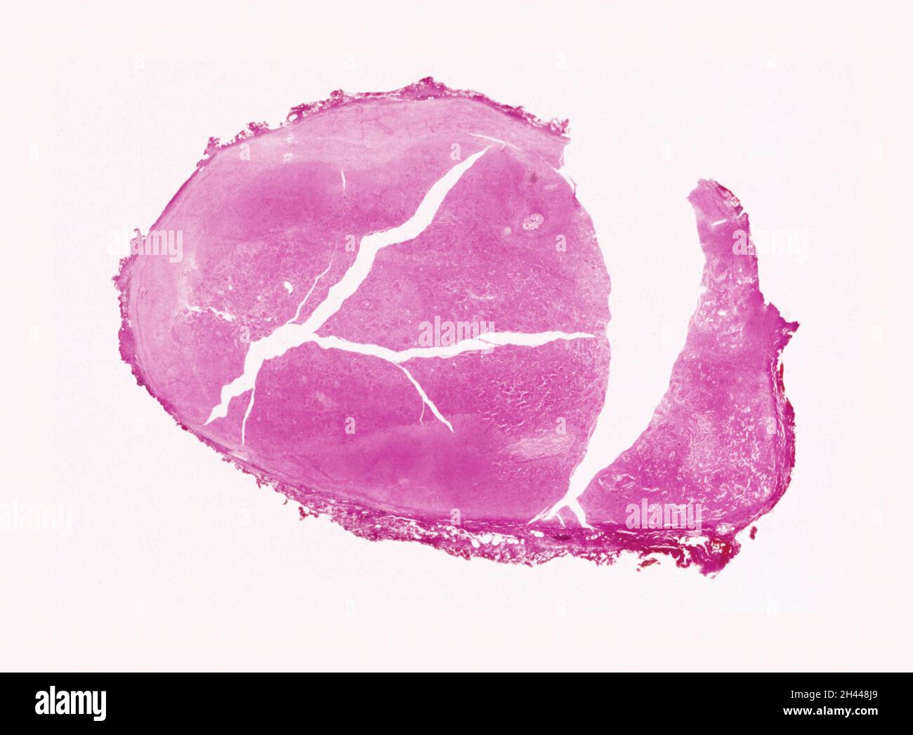 Polmone: Istoplasmosi Foto Stock