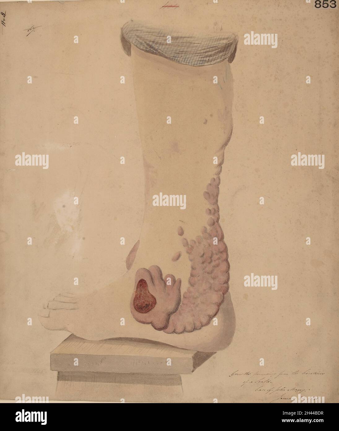 Gamba e piede con estese crescite di keloide nelle cicatrici a seguito di un'ustione Foto Stock