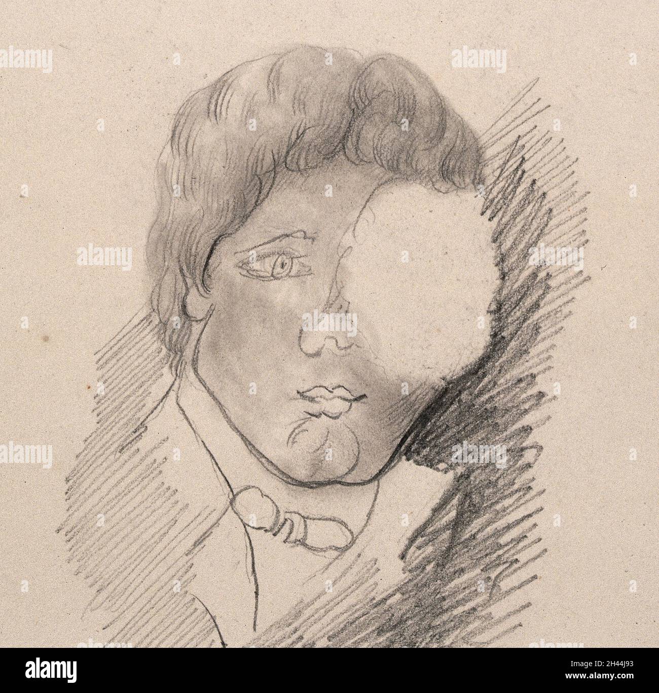 Il volto di un uomo con un gonfiore sull'occhio sinistro. Disegno. Foto Stock