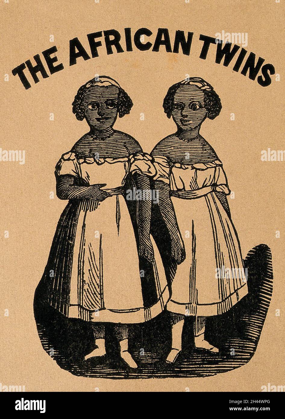 Gemelli congiunti, noti come gemelli africani. Incisione in legno. Foto Stock