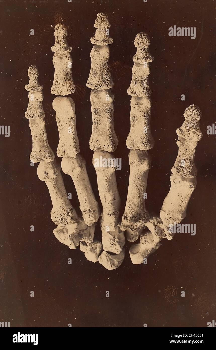 Ossa della mano destra che illustrano le apparenze associate all'osteoartropatia polmonare Foto Stock