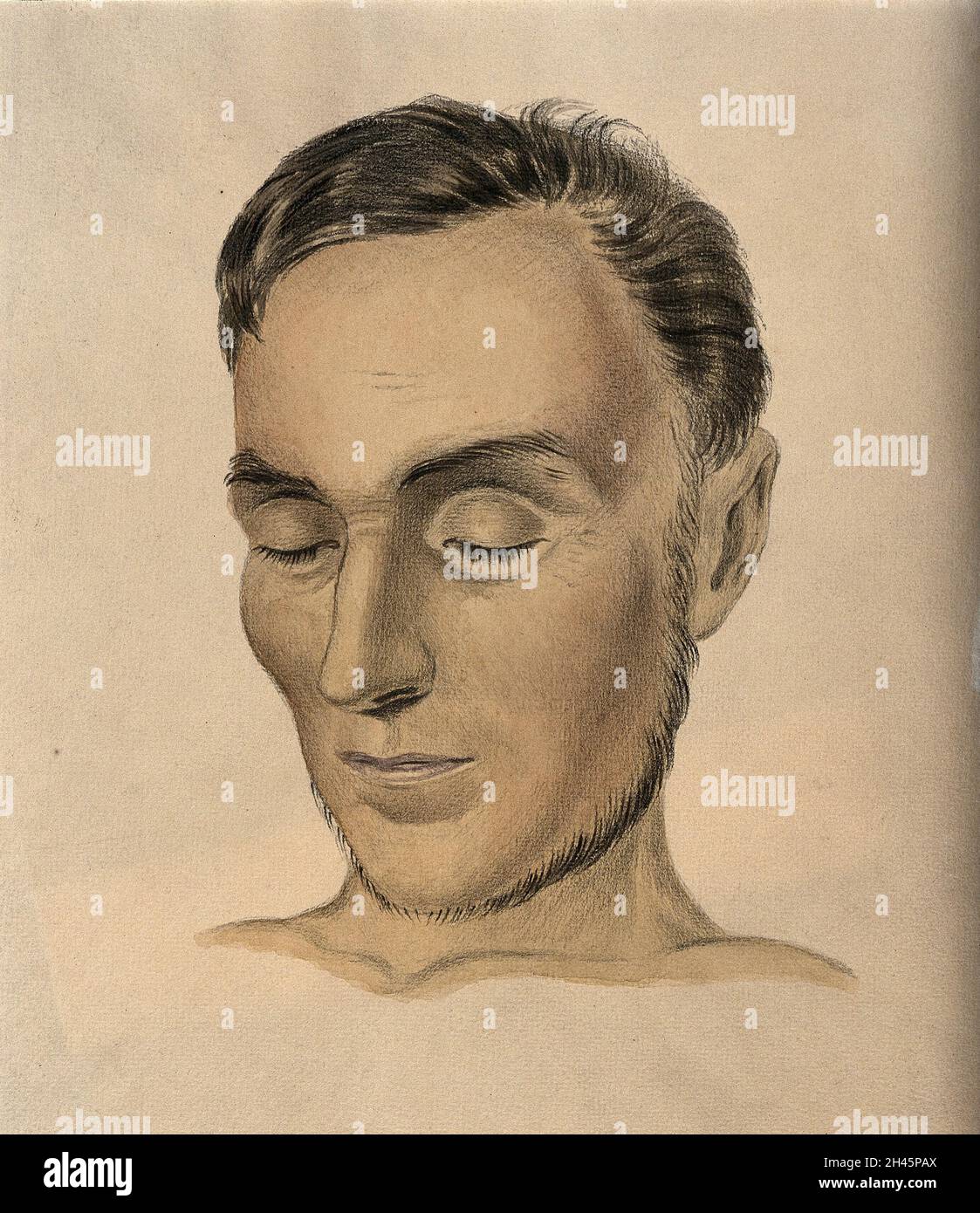Volto di un uomo affetto dal morbo di Addison. Acquerello con gesso, 1849. Foto Stock