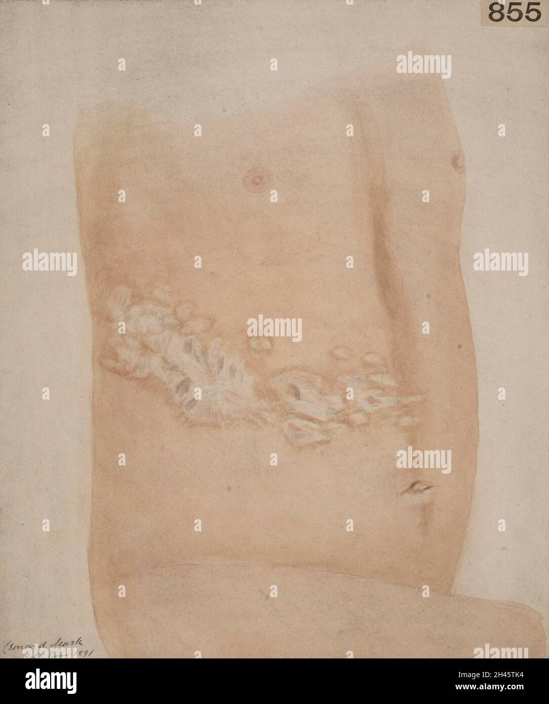 Condizione keloide delle cicatrici dopo un attacco di herpes zoster Foto Stock