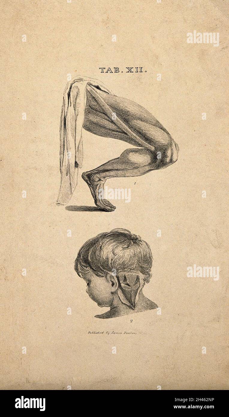 Arto inferiore: Gamba écorché che mostra il muscolo sartoriale, e una parziale dissezione della parte posteriore del collo di un bambino. Litografia, 1825/1845(?). Foto Stock