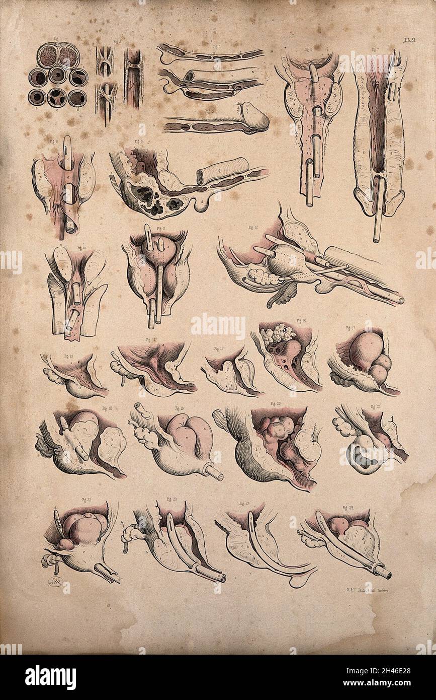 La chirurgia di ostruzioni nell'uretra di un uomo. Litografia colorata da J. Maclise, 1851. Foto Stock
