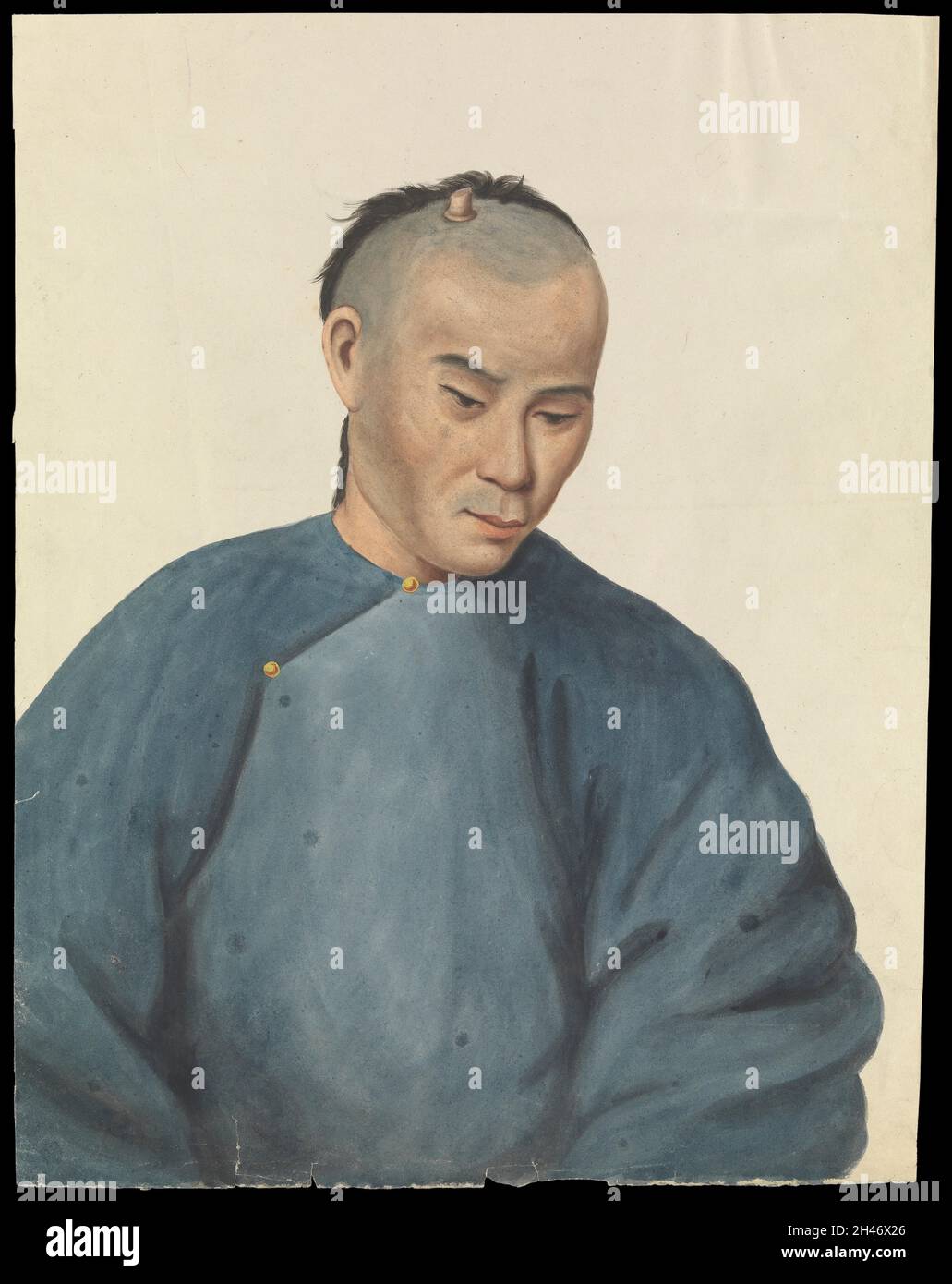 Un uomo con una crescita cutanea simile al corno sul cuoio capelluto. Gouache, 18--, dopo Lam qua, ca. 1837. Foto Stock