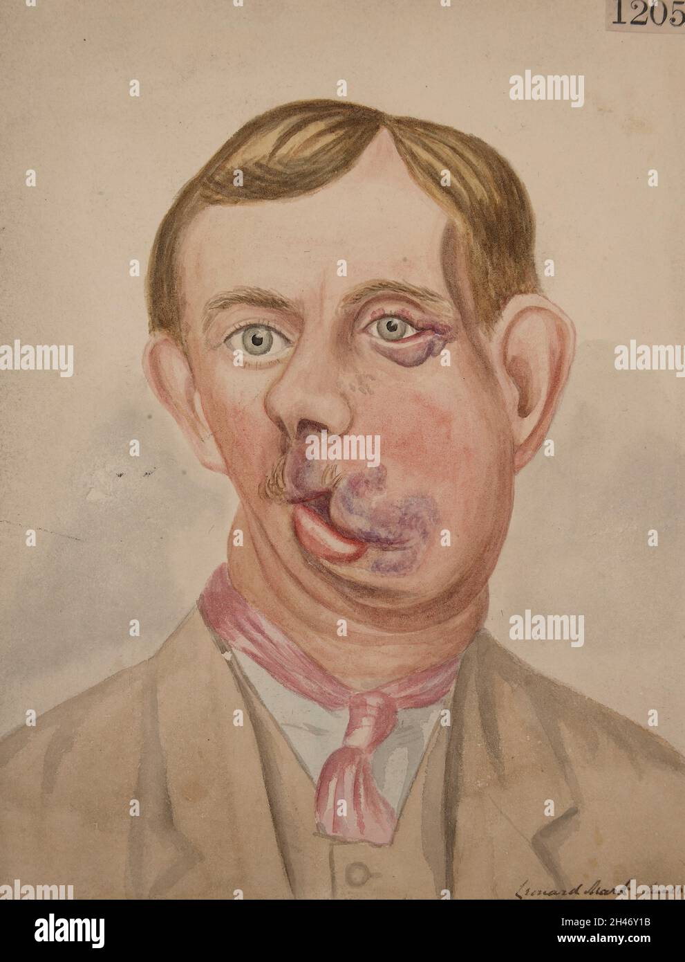 Uomo con un grande naevus congenito sul lato destro del volto Foto Stock