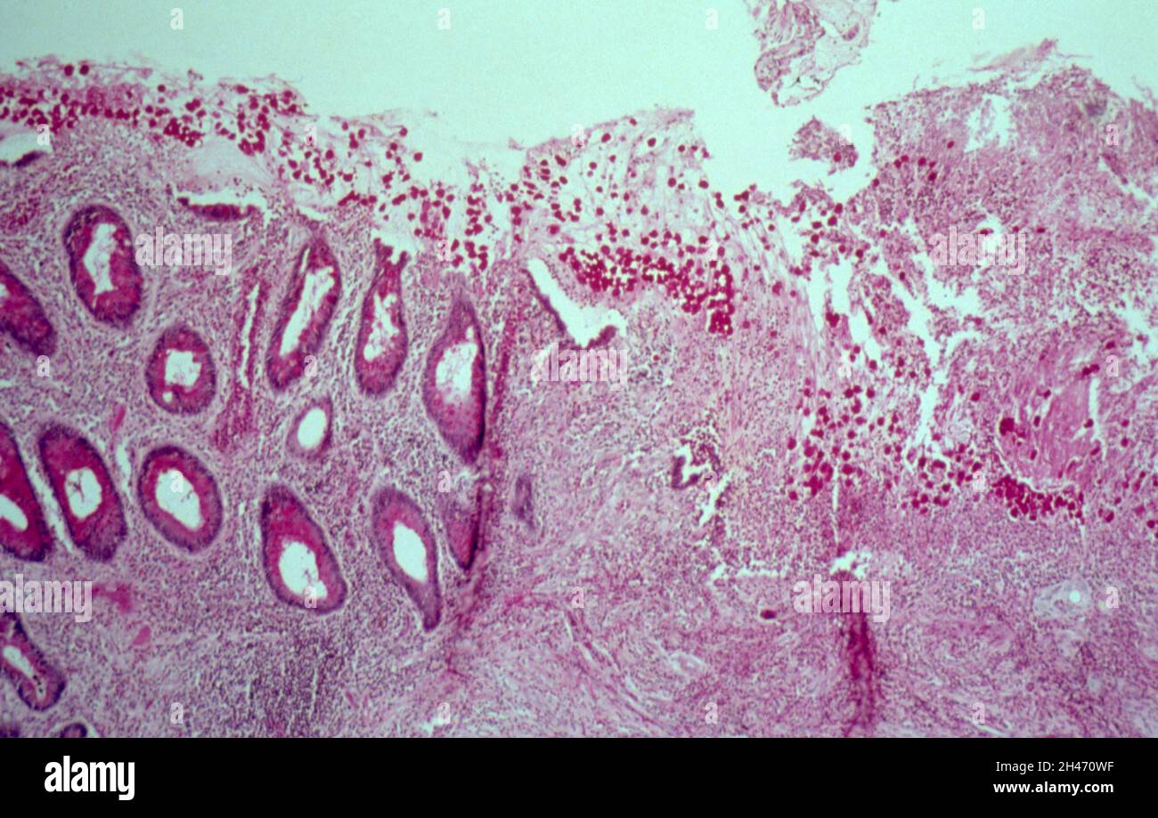 Amebiasi: Retto Foto Stock