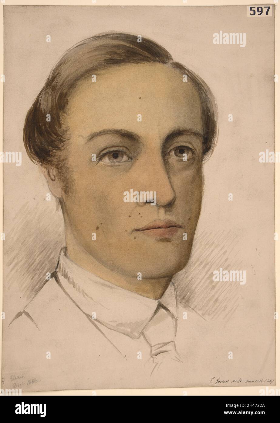 Faccia di un uomo con bronzazione profonda della pelle associata con la malattia di Addision Foto Stock