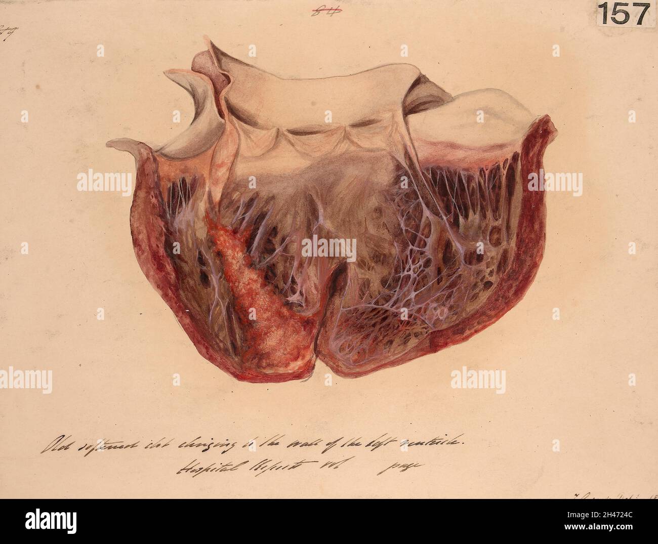 Cuore con un vecchio coagulo ammorbidito che si aggrappa alla parete del ventricolo sinistro Foto Stock