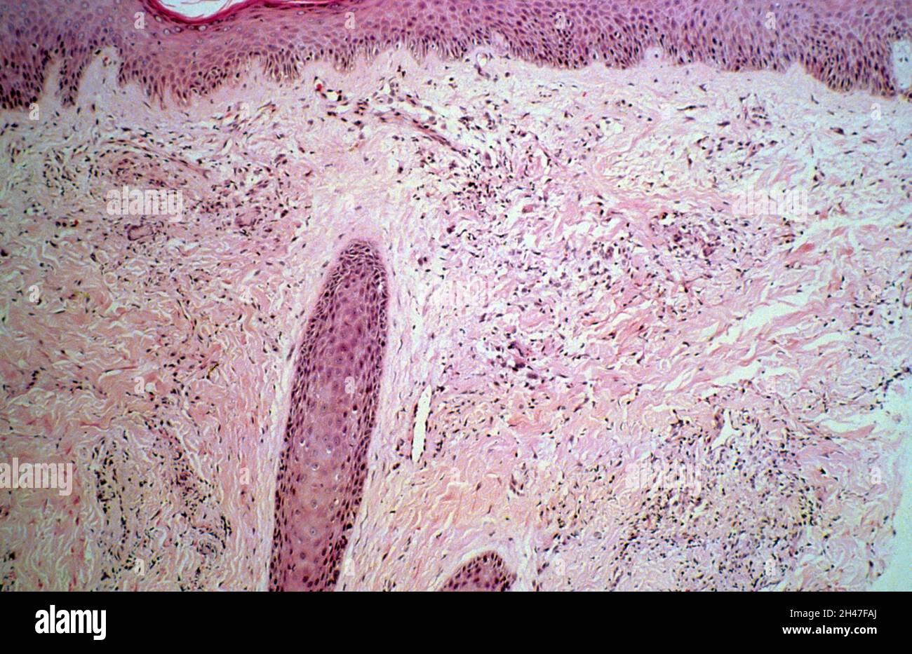 Pelle: Istoplasmosi disseminata Foto Stock