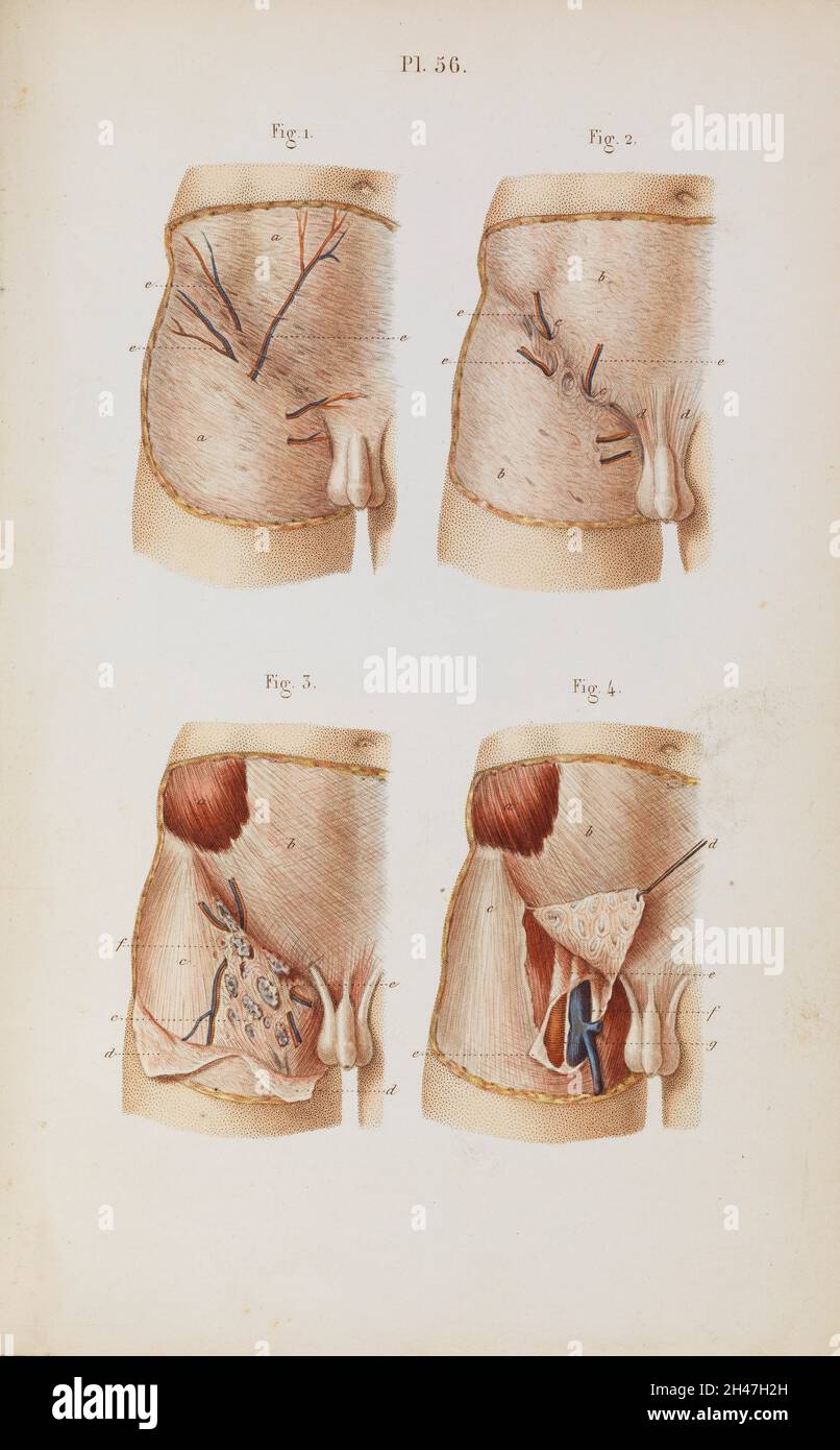 Piastra 56, anatomia chirurgica dell'area inguinale. Foto Stock