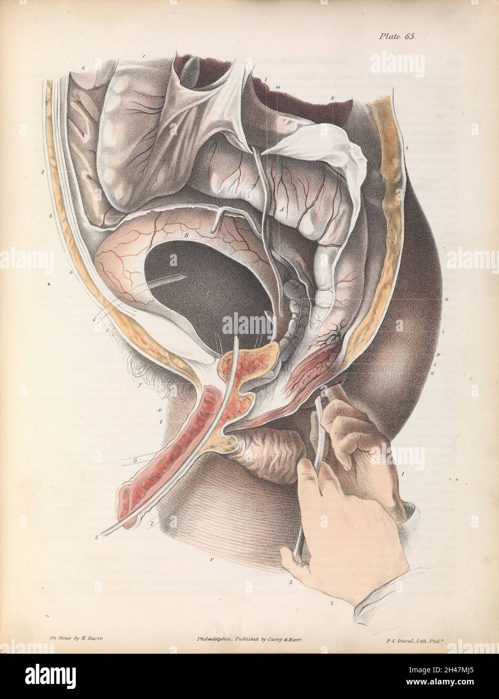 Piastra LXV. Anatomia chirurgica per la perforazione della vescica. Foto Stock