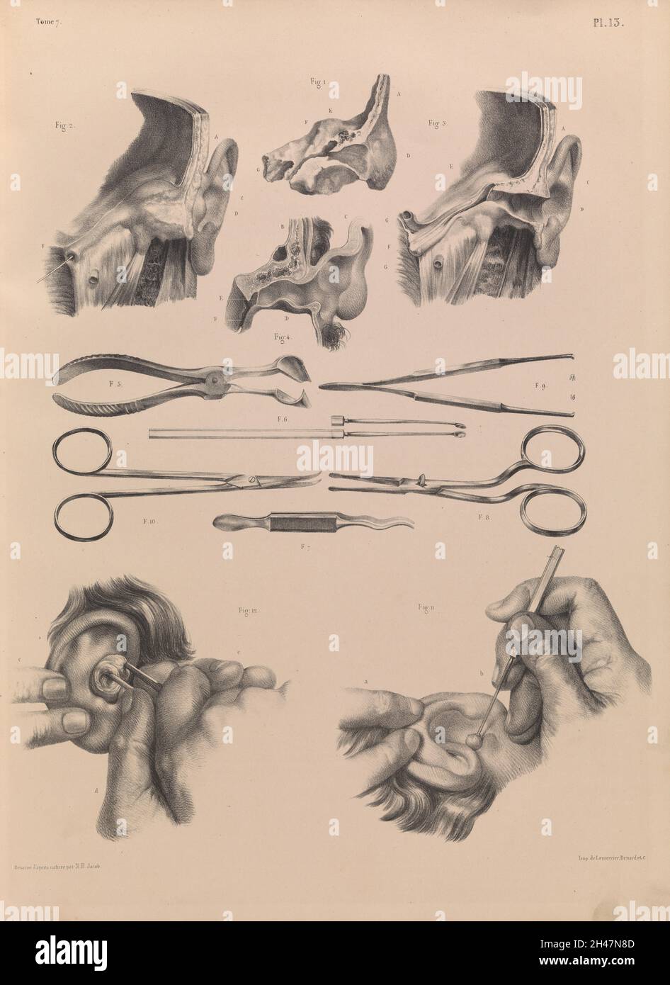 Piastra 13. Anatomia chirurgica dell'orecchio Foto Stock