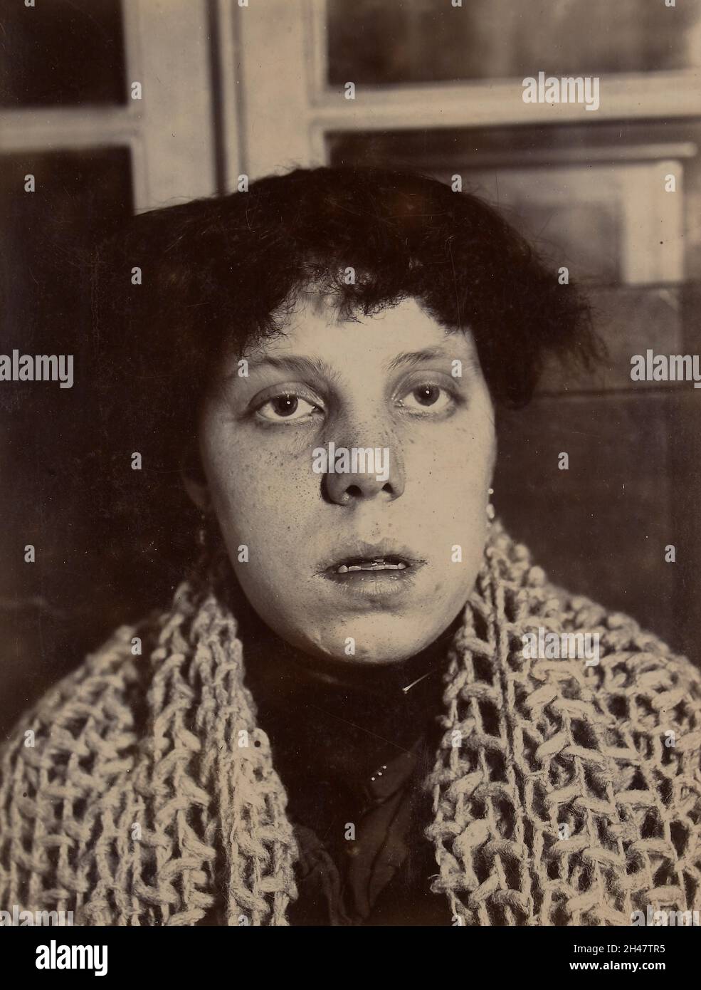 Donna che mostra il tipico aspetto facciale che accompagna le vegetazioni adenoidi Foto Stock