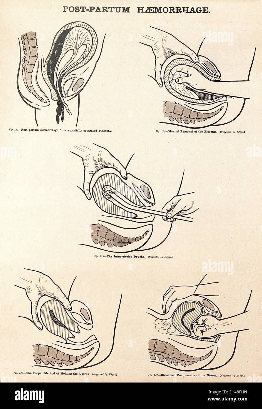 Emorragia post-partum. Litografia dopo W. F. Victor Bonney. Foto Stock