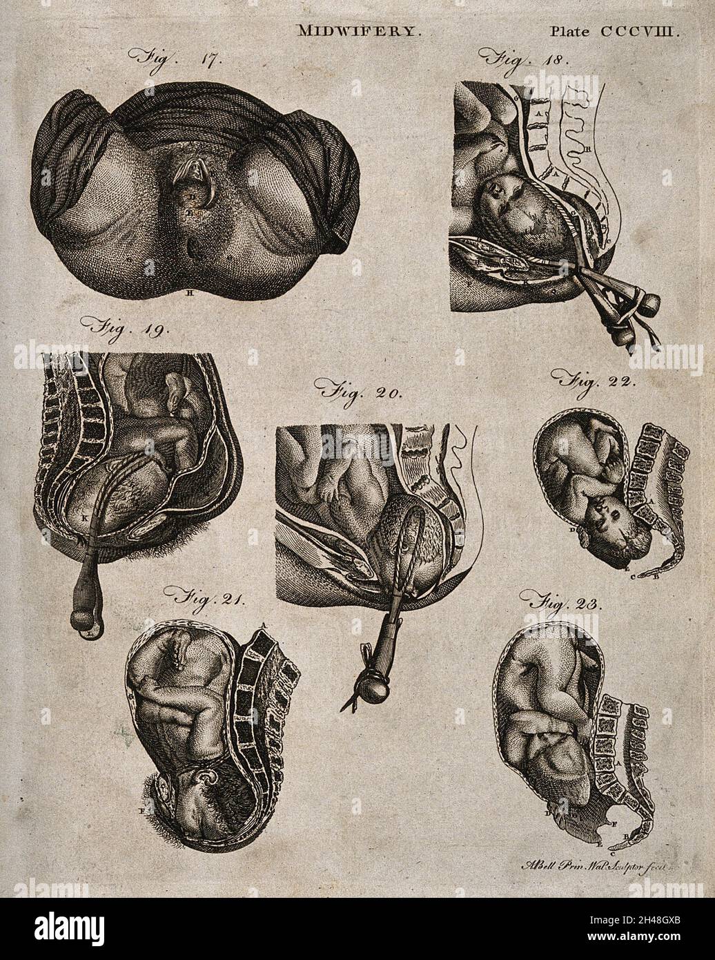 Sette diagrammi che illustrano la nascita di un bambino con l'uso di forcipe. Incisione di A. Bell. Foto Stock