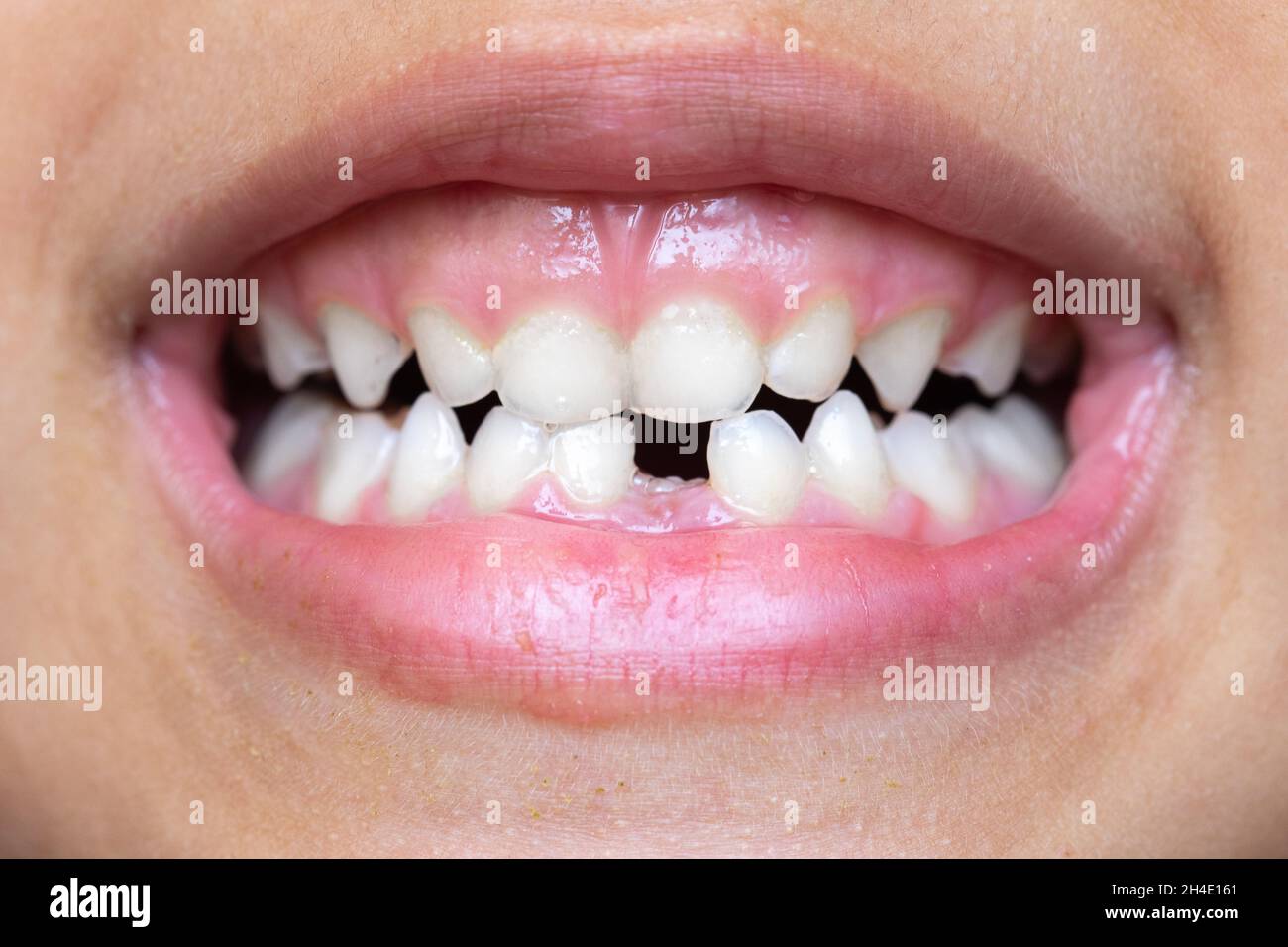 Macro della bocca di una bambina che ha perso un dente Foto Stock