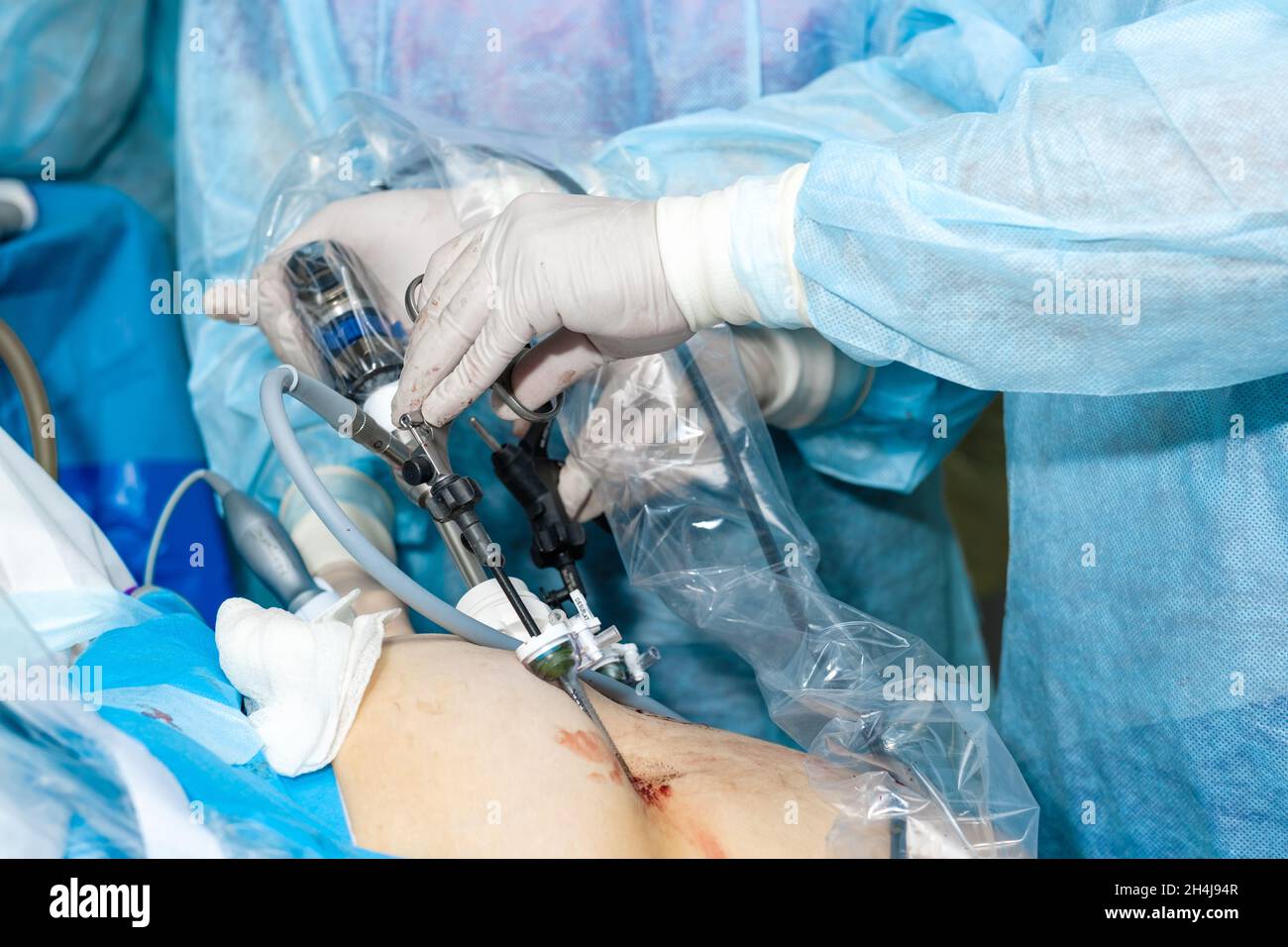 Mani di chirurghi con manipolatori chirurgici laparoscopici durante la chirurgia proctologica. Messa a fuoco selettiva. Foto Stock