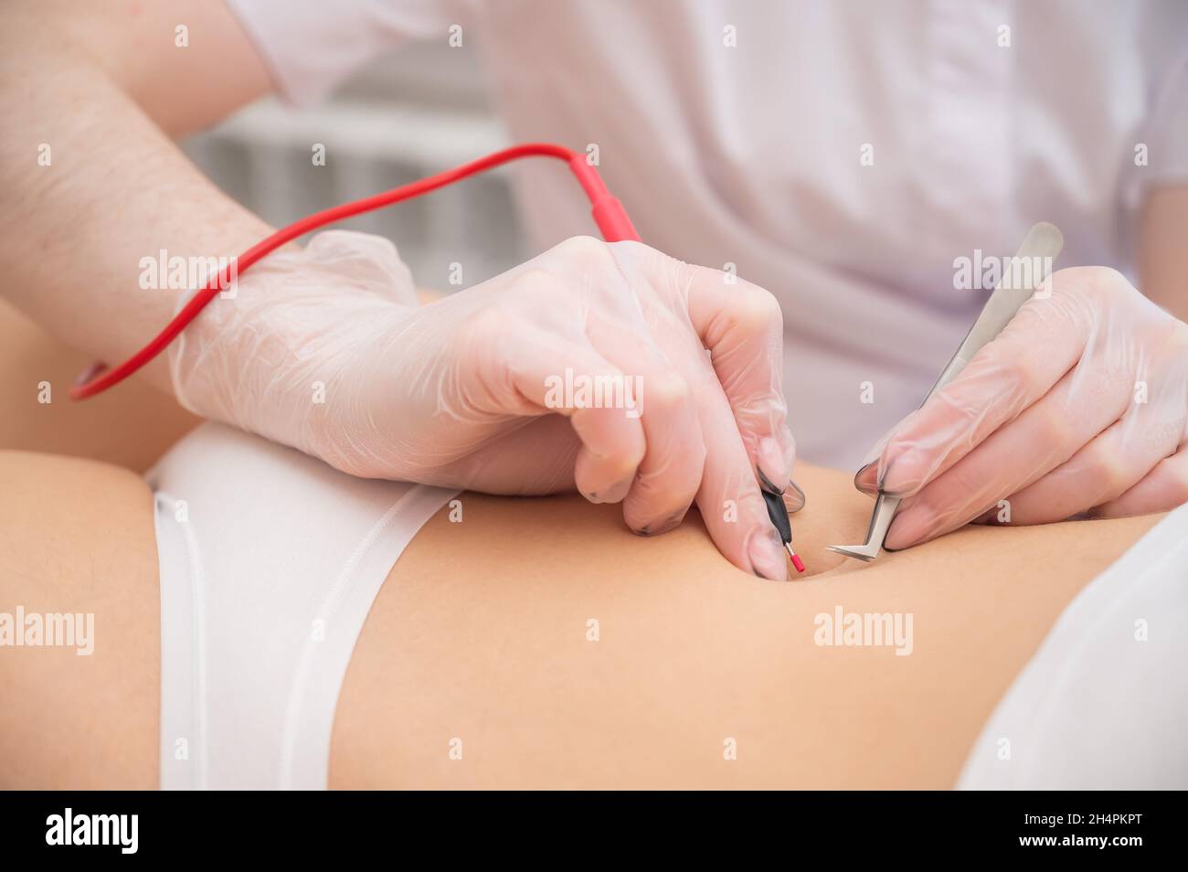 Donna in epilazione elettronica sulla pancia. Rimozione permanente  dell'hardware dei peli addominali indesiderati Foto stock - Alamy