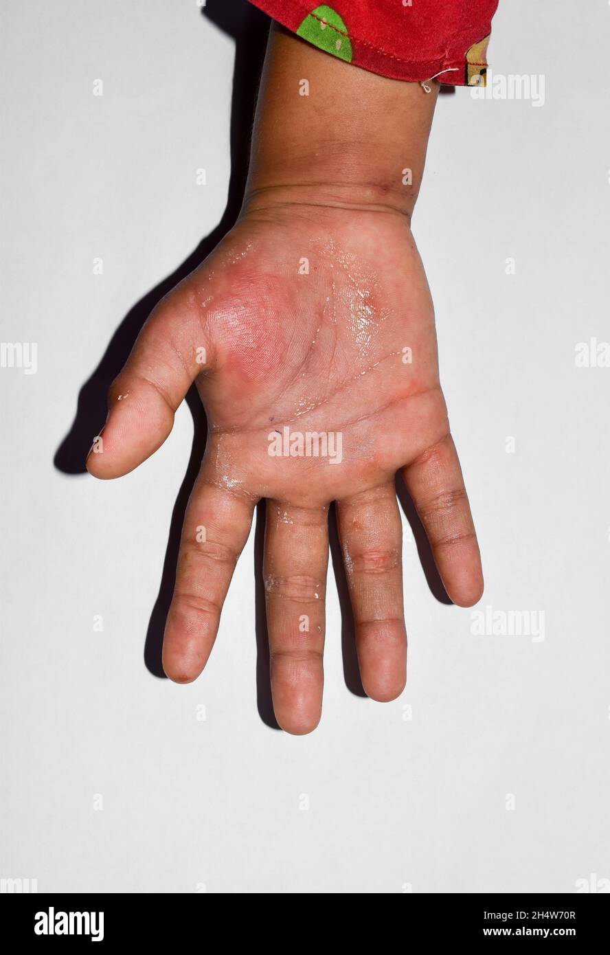 Edema unilaterale con scabbia dell'arto superiore. Gonfiore della mano e del braccio del bambino asiatico. Foto Stock