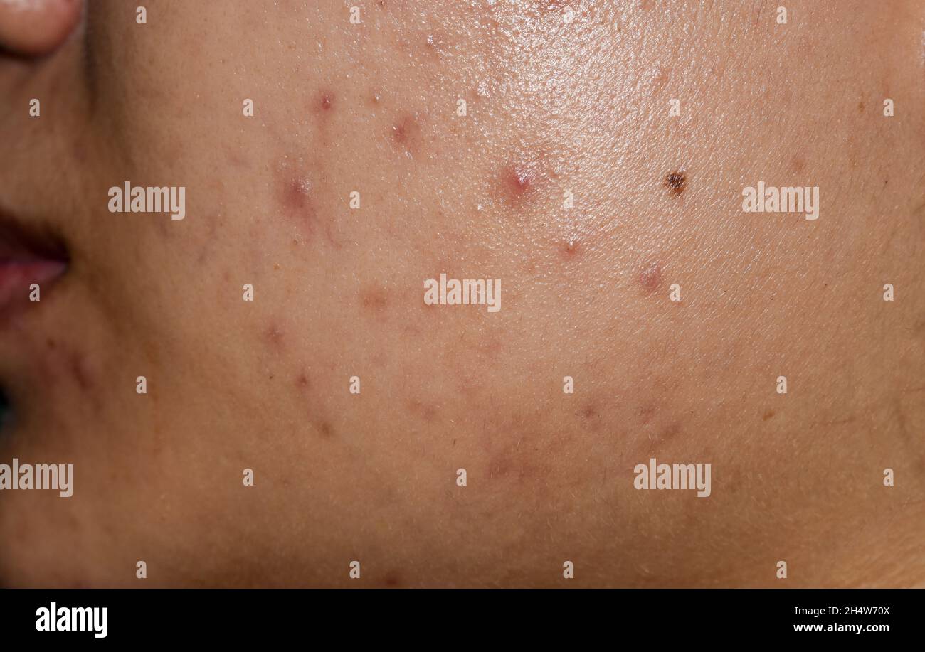 Acne , macchie nere e cicatrici sulla faccia della giovane donna asiatica. Foto Stock