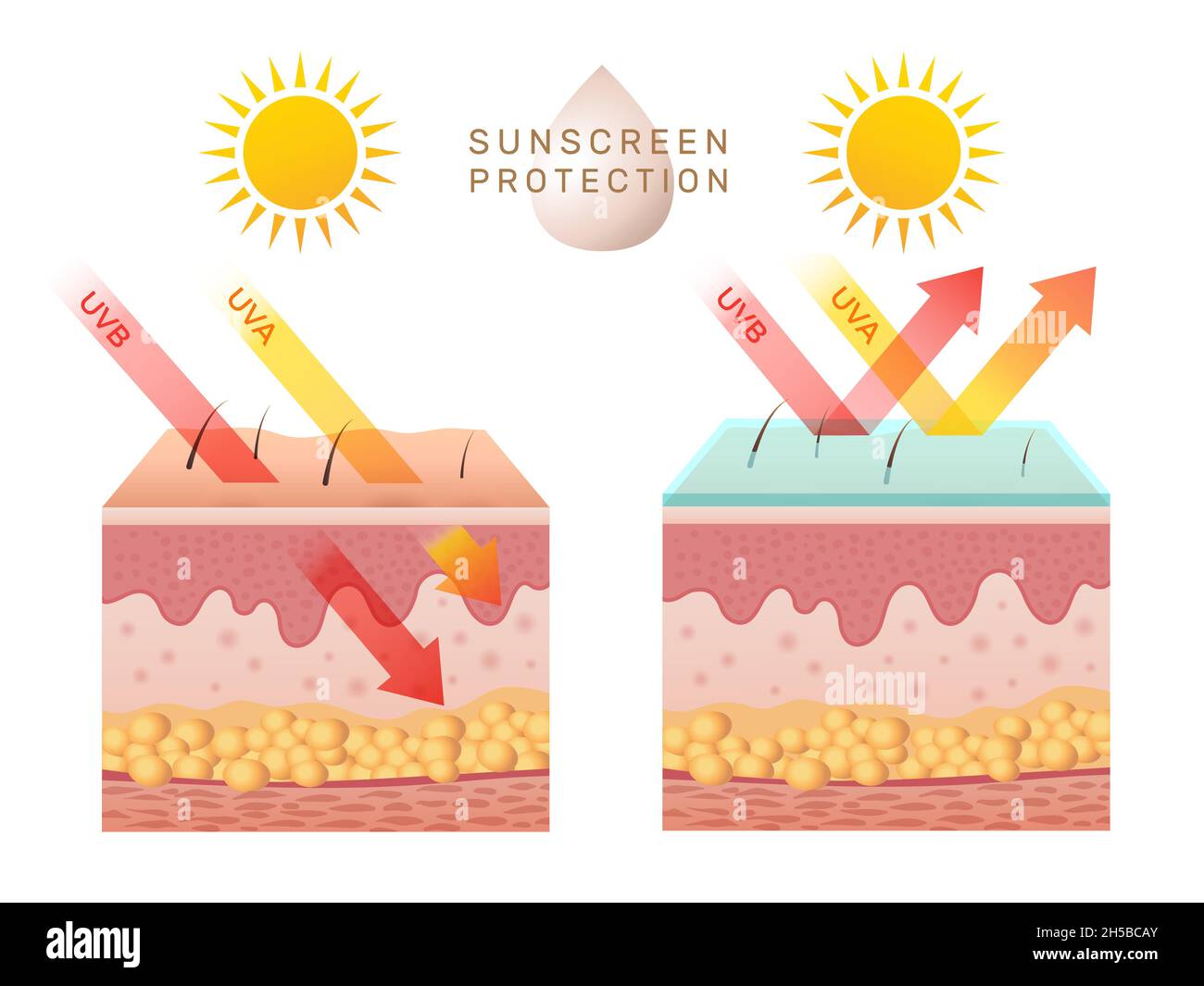 Protezione della pelle dai raggi UV. Bucce della pelle umana danneggiate prima e dopo la protezione solare corpo strati adiposi epidermide recente modello infografico vettoriale Illustrazione Vettoriale