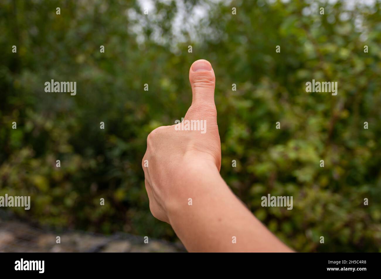 Pollice insolitamente corto, chiamato anche pollice a forma di clubed o stub, e medico indicato come Brachydactyly tipo D. Foto Stock