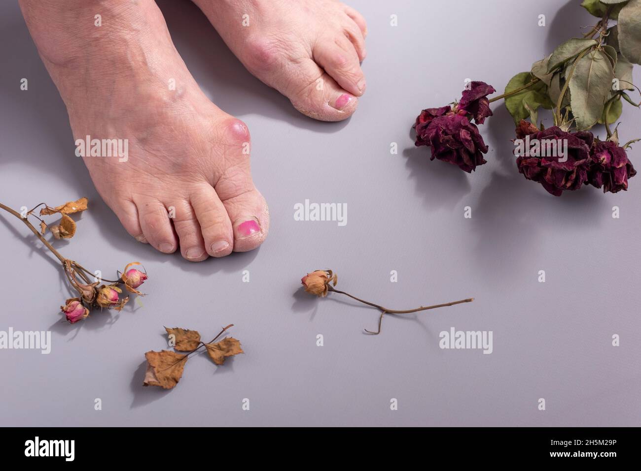 concetto di malattia del piede in donna anziana con fiori secchi Foto Stock