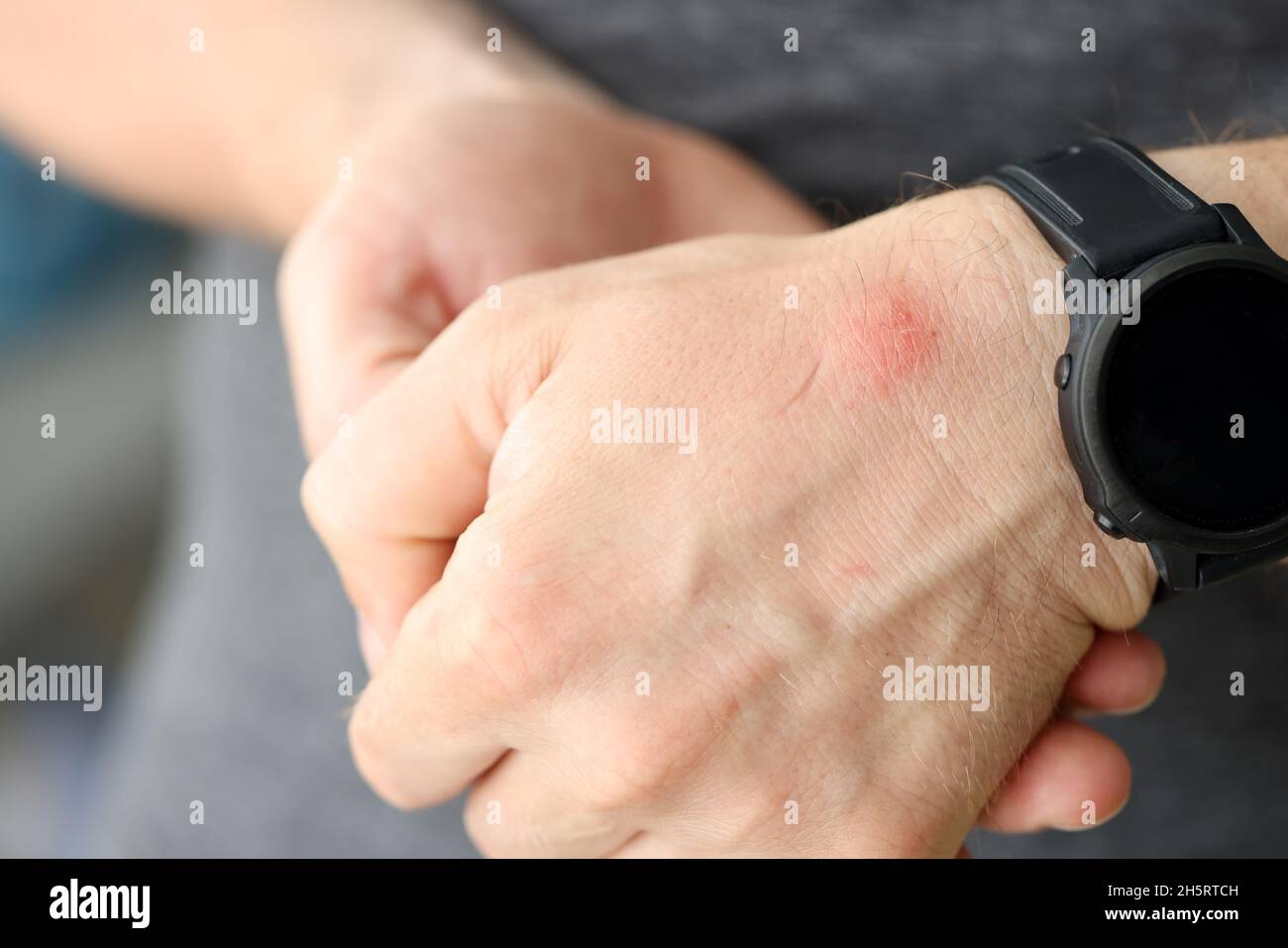 Primo piano di macchia rossa sulla pelle della mano dell'uomo Foto stock -  Alamy
